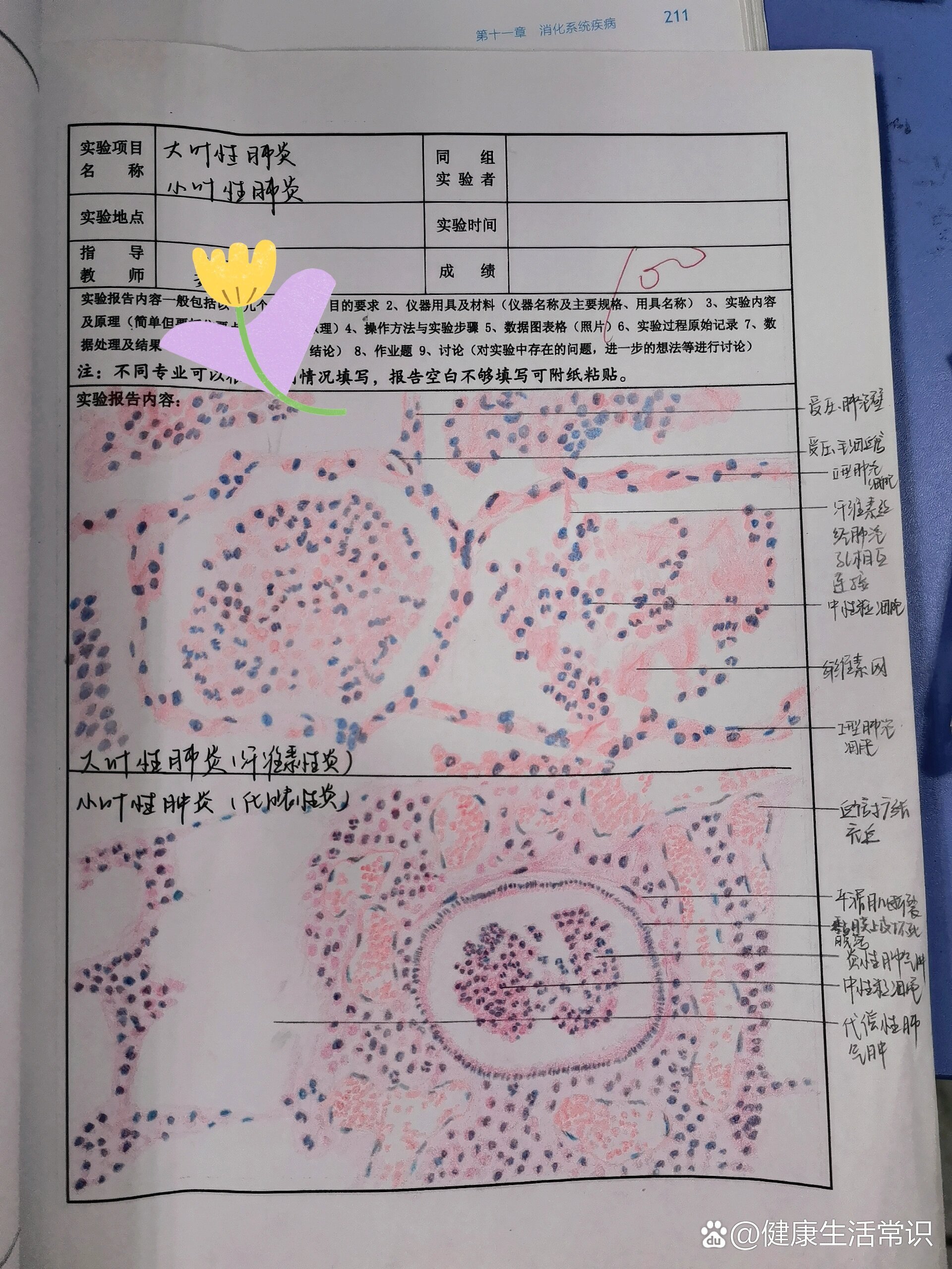 肺水肿红蓝铅笔图片