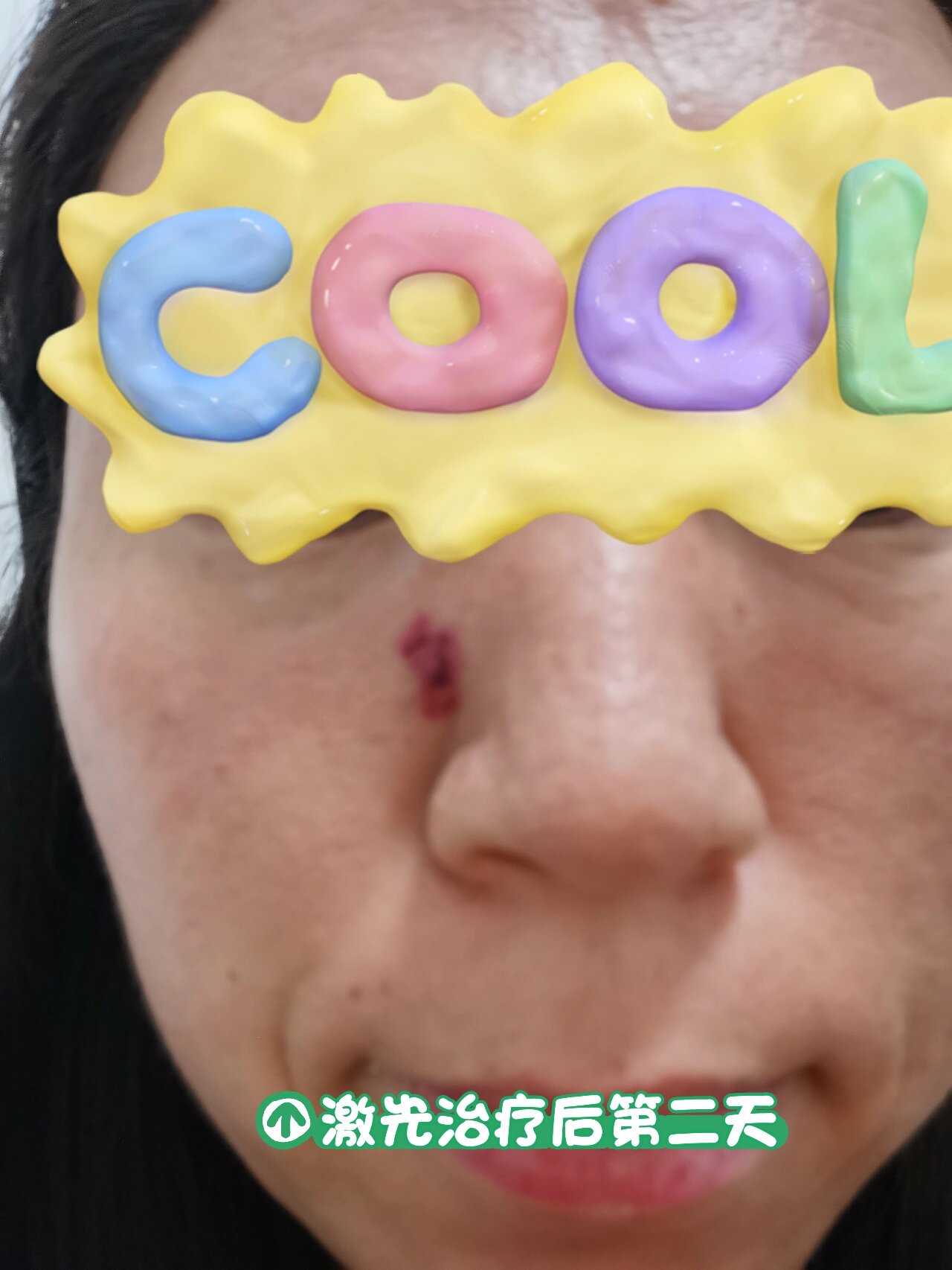 血管瘤激光治疗