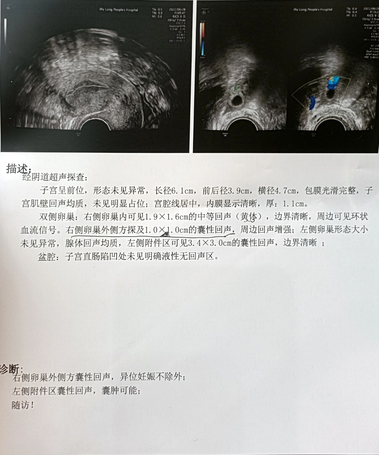 宫外孕术后一个月,记录