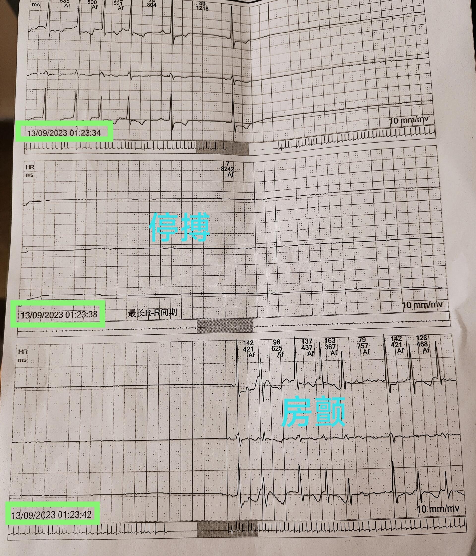室性停搏心电图图片