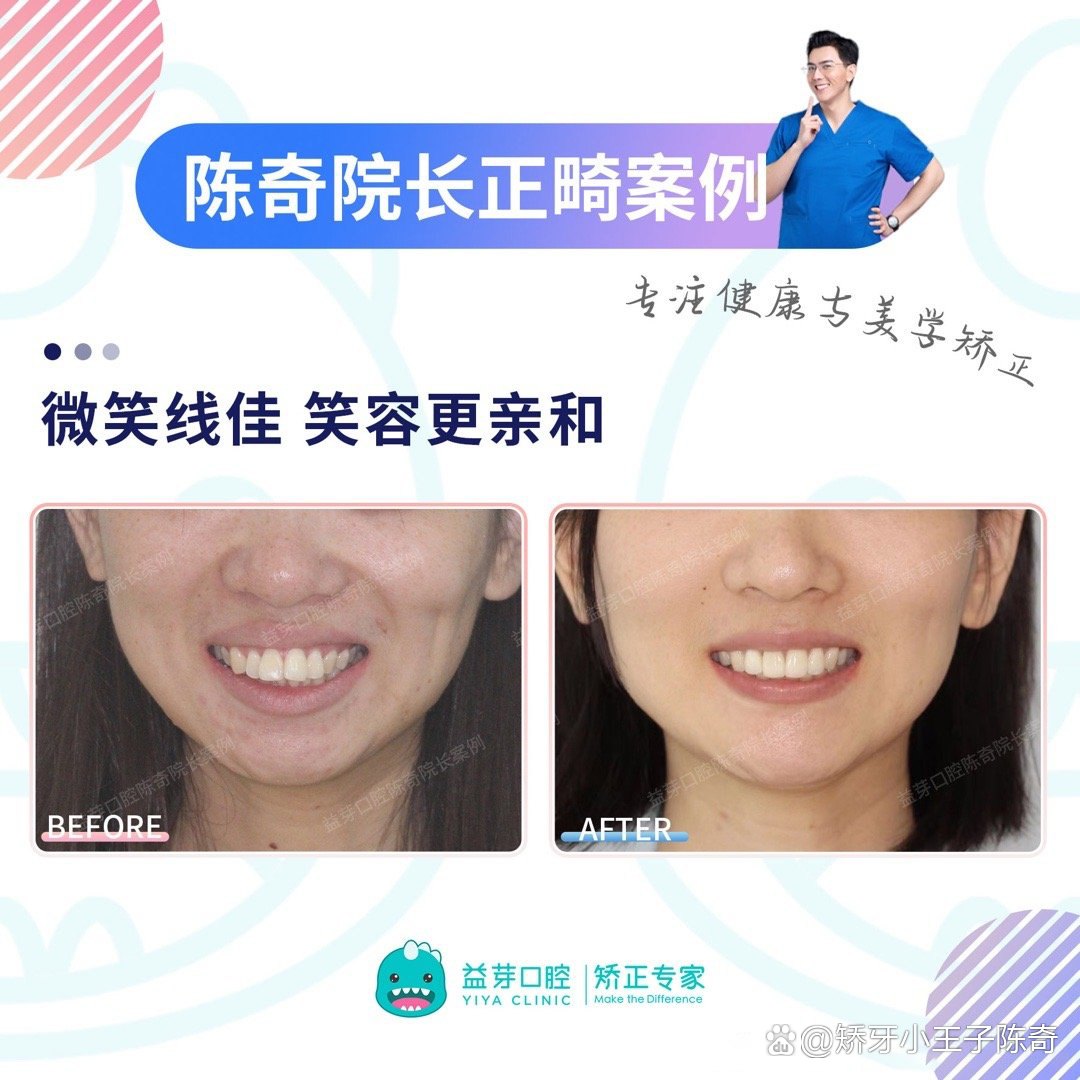 【什么是笑线？