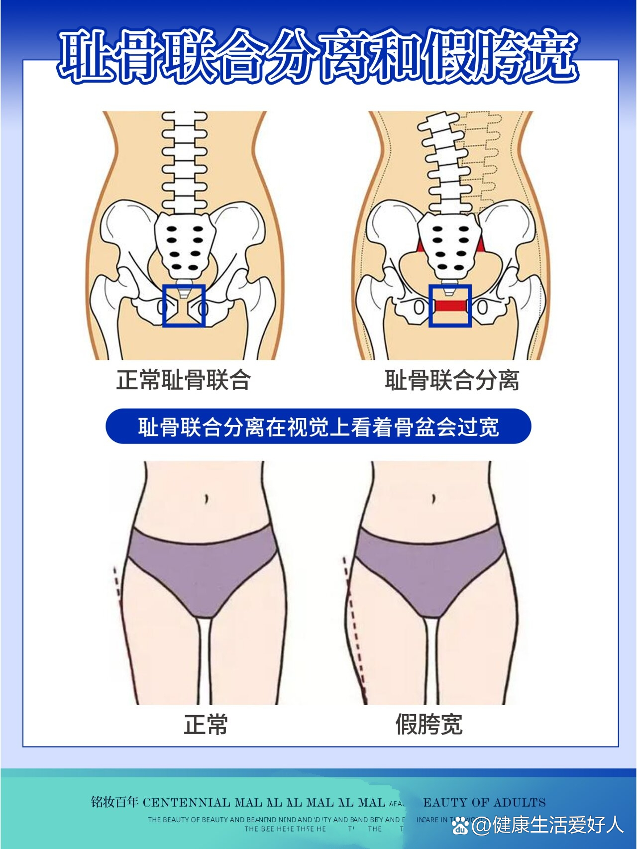 髋骨突出是什么原因图片