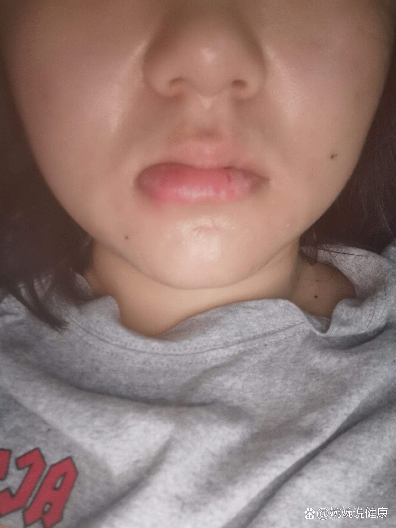 下嘴唇突然就肿了