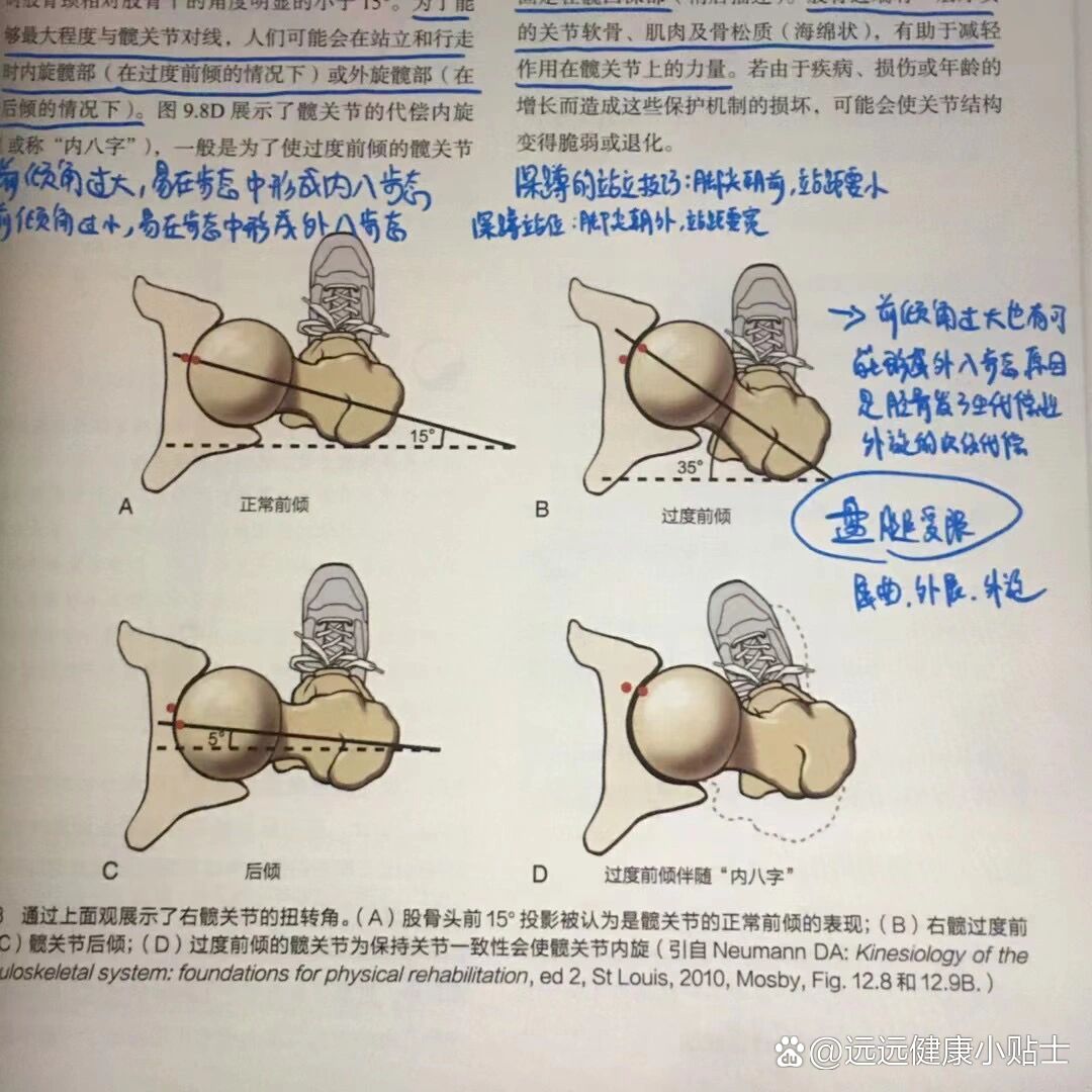 决定天生内八脚或外八脚的股骨前倾角