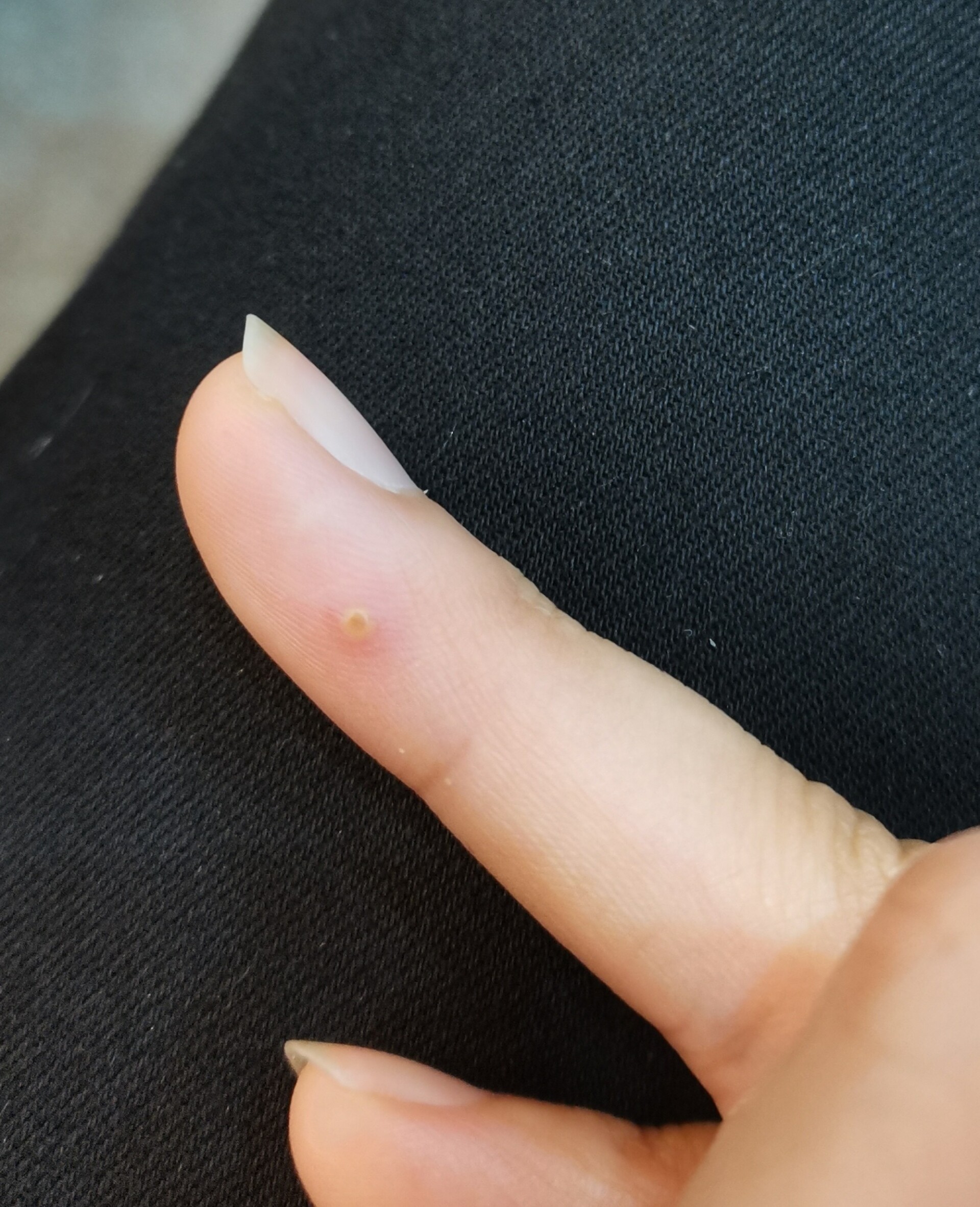 手上长了个痘痘一样的东西