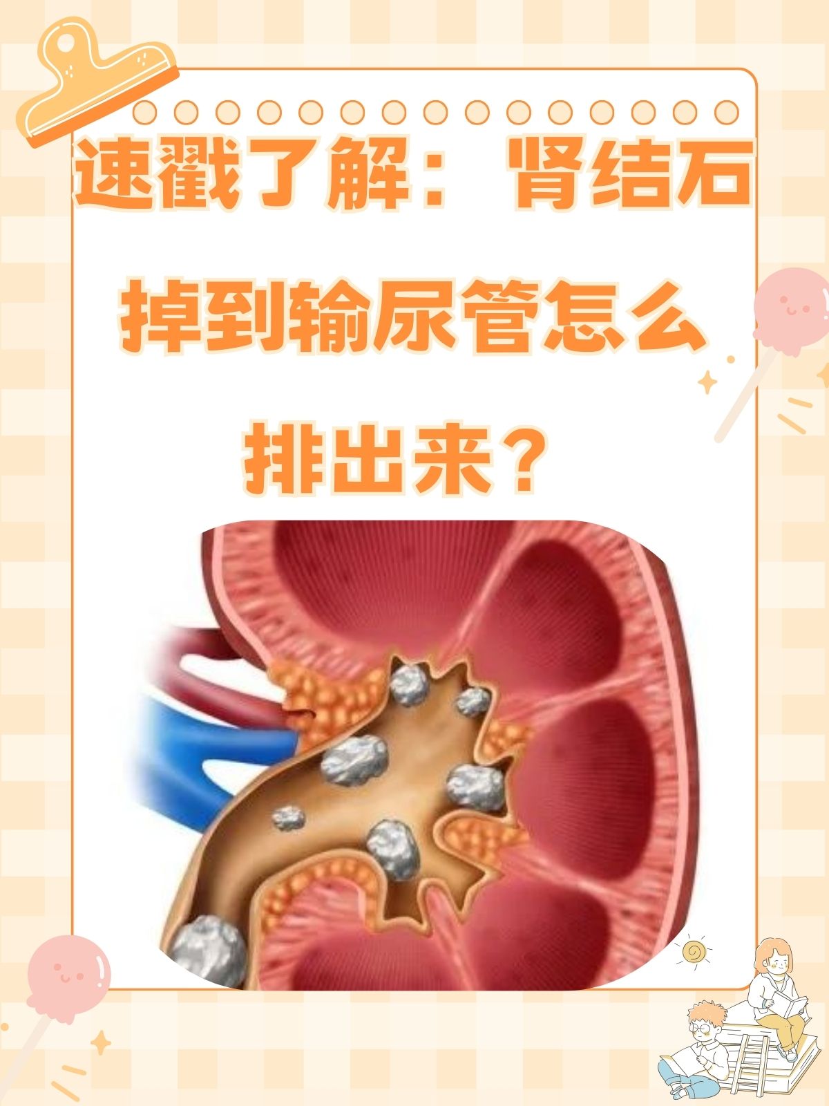 速戳了解 肾结石掉到输尿管怎么排出来?