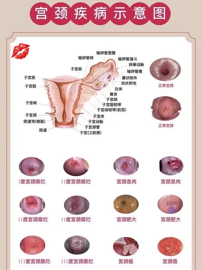 宫颈构造示意图图片