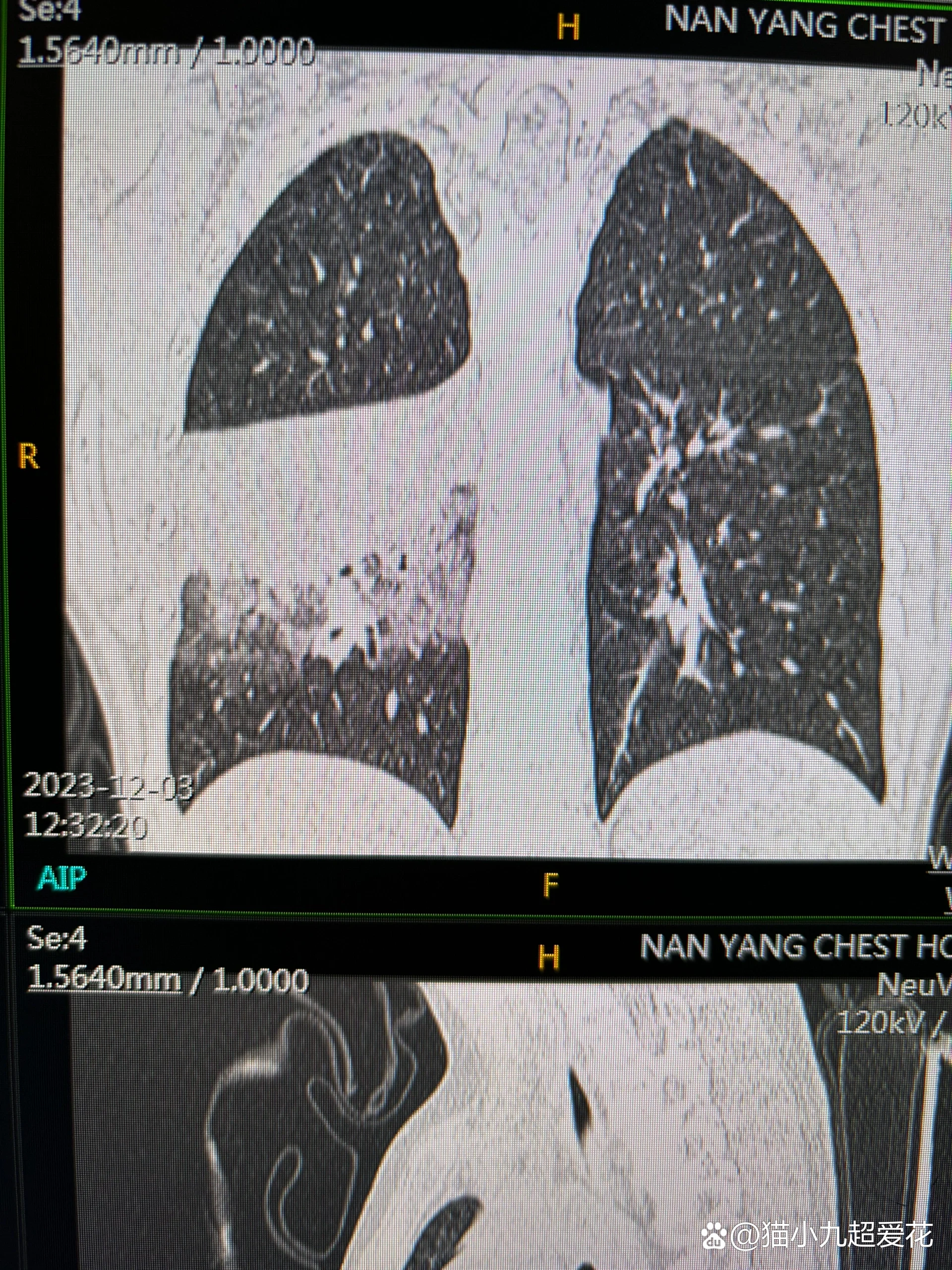 病毒性肺炎ct影像图片图片