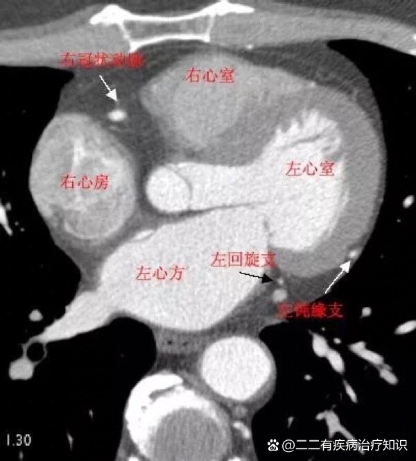 02心脏ct解剖图