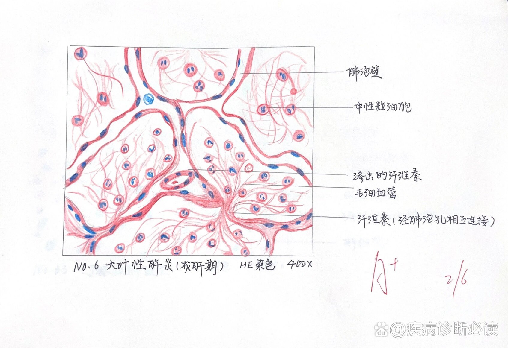 病理学红蓝铅笔绘图【大叶性肺炎灰肝期】