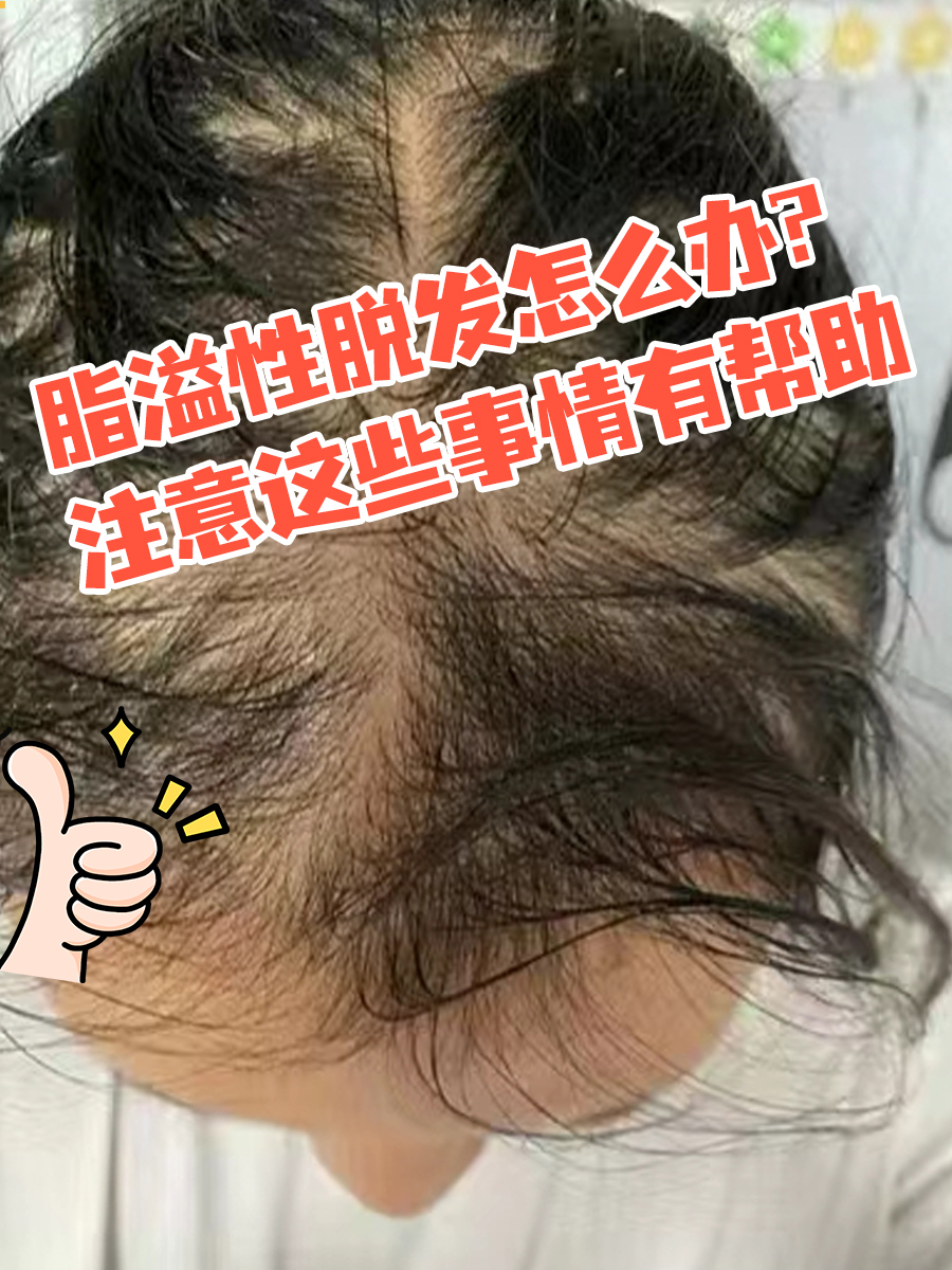 脂溢性脱发怎么办?注意这些事情有帮助