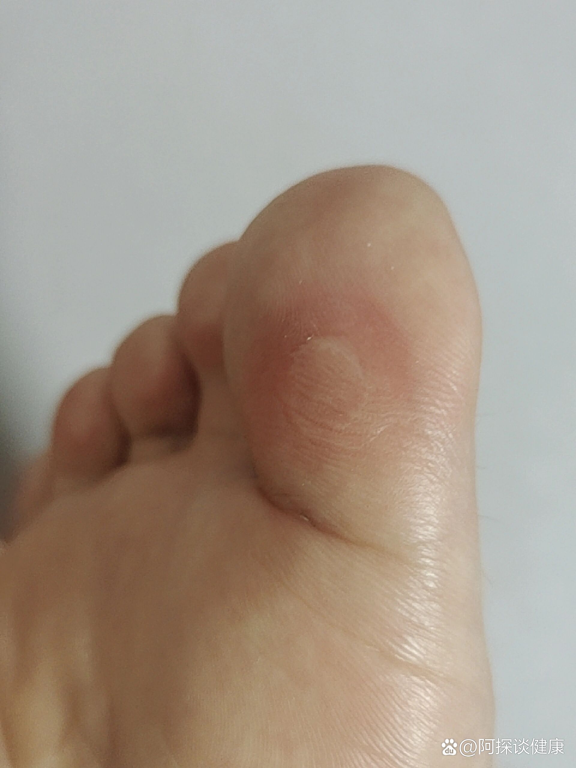 跳绳脚趾起泡了