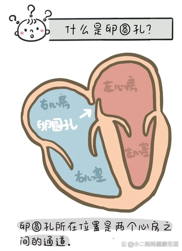 卵圆孔未闭解剖图图片