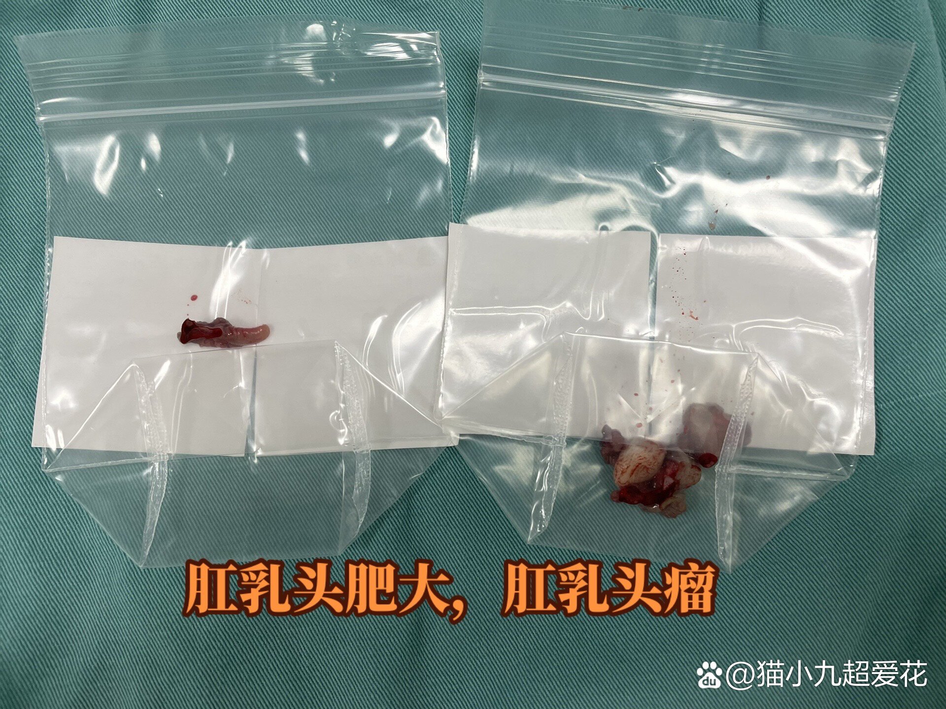 肛乳头肥大,肛乳头瘤