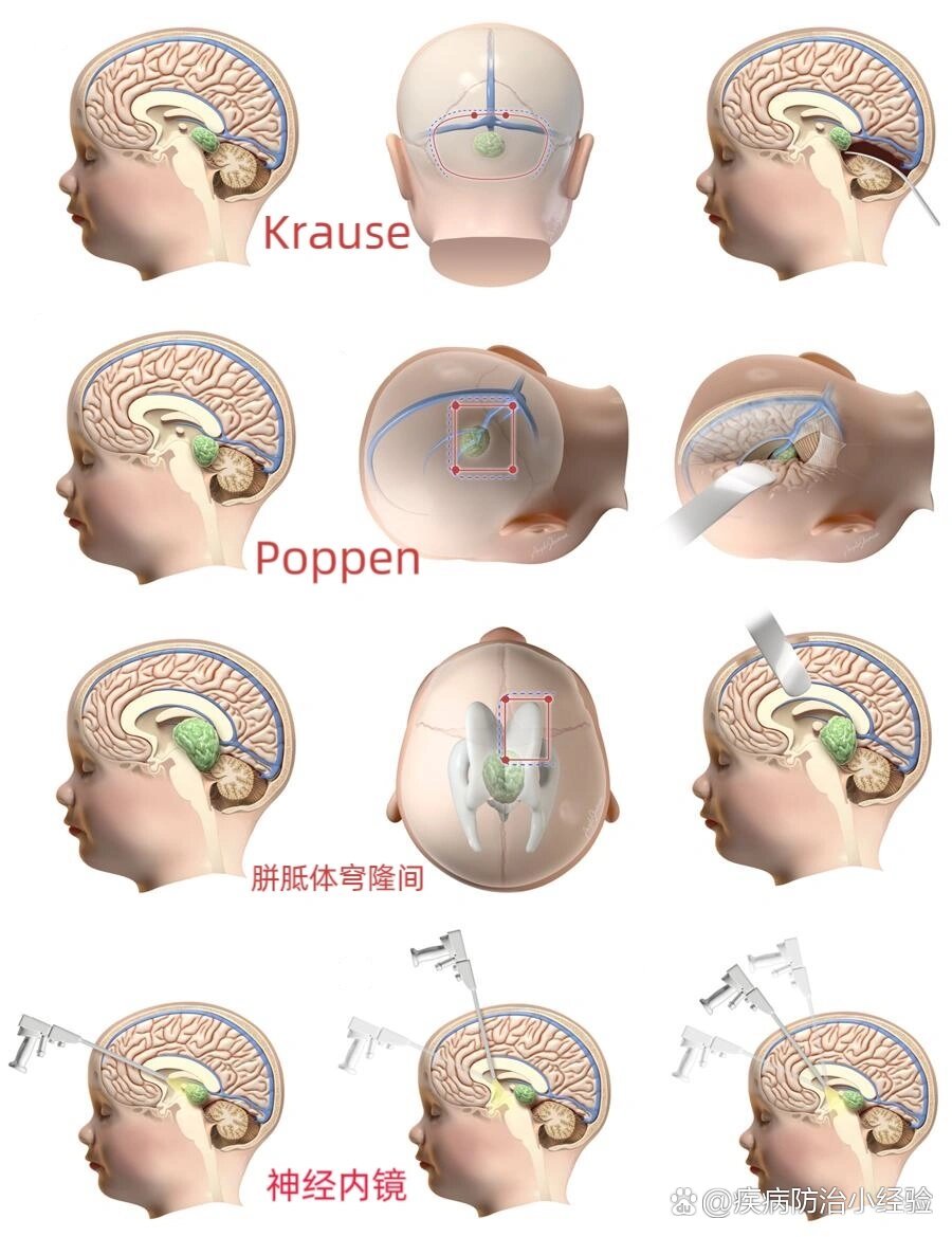 儿童松果体钙化图片