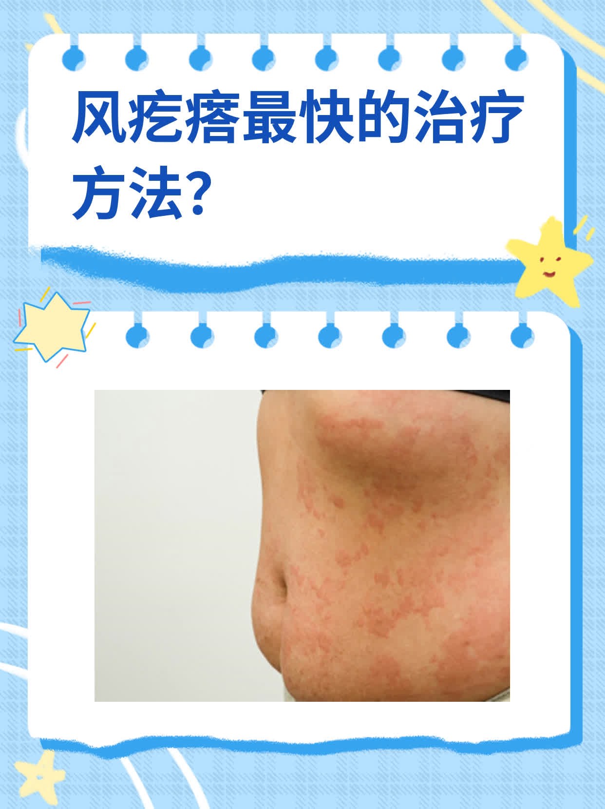 风疙瘩最快的治疗方法