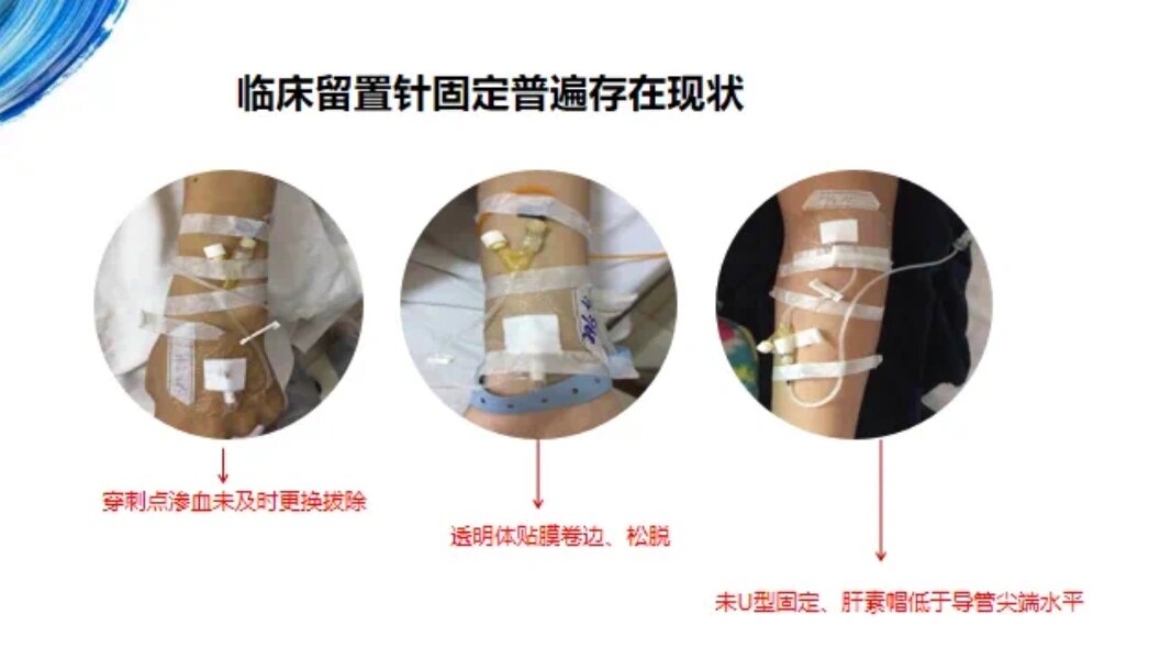 输液胶贴三条固定图解图片