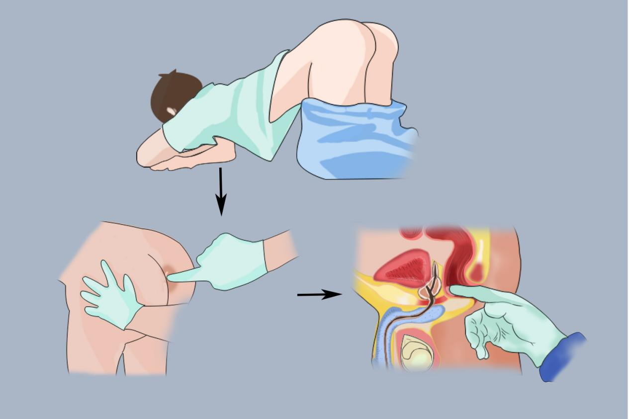 前列腺 按摩
