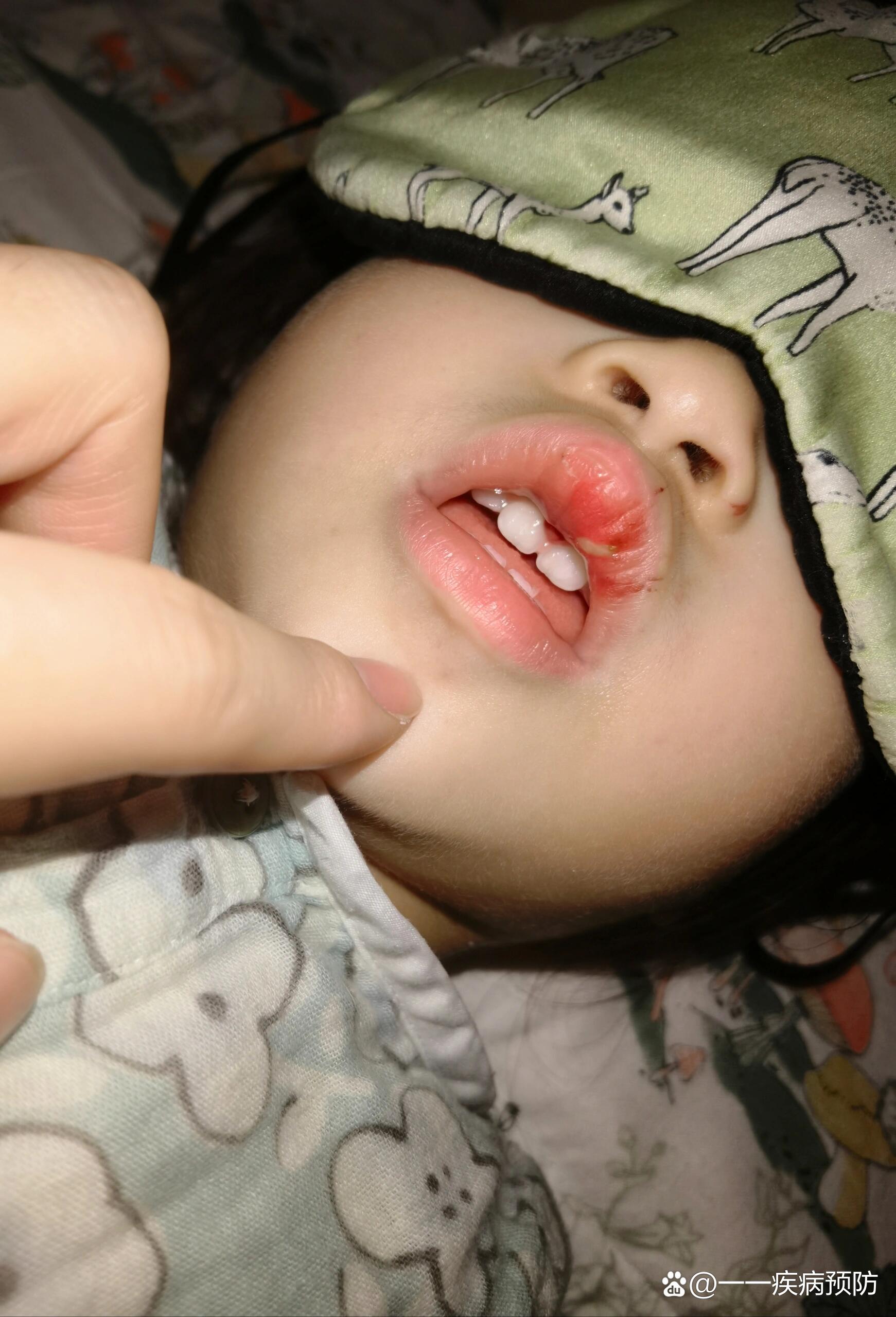 25个月摔断唇系带后续——长好啦!