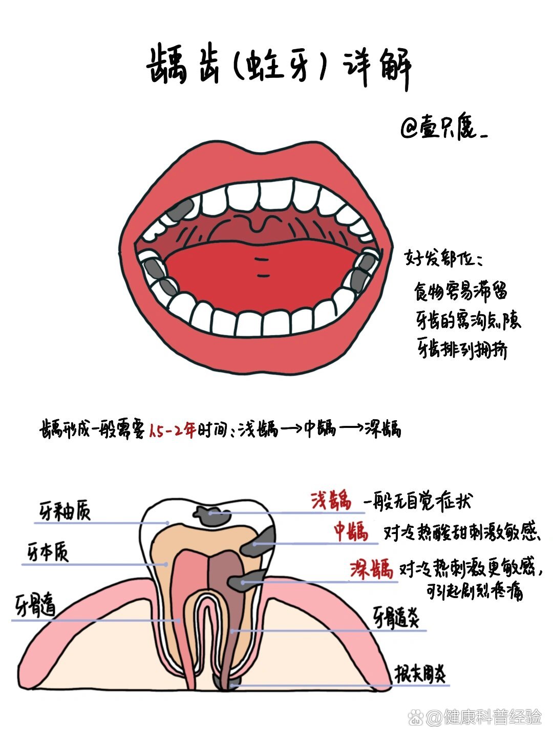 龋齿深浅程度判断图片图片