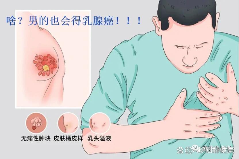 男性也能得乳腺癌?