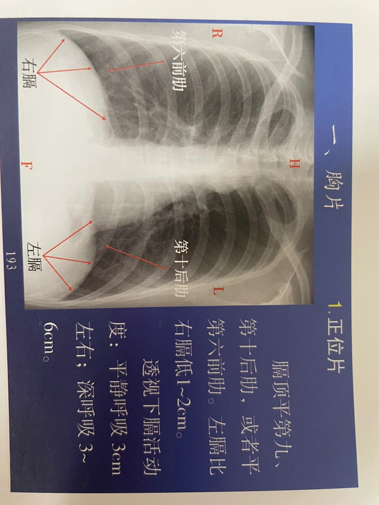 胸部正位DR详细解剖