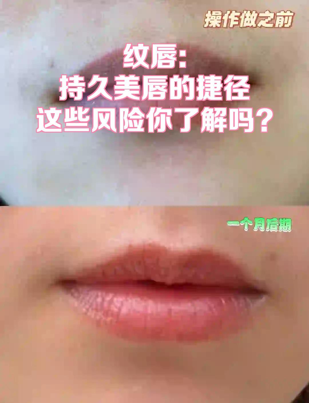 纹唇：持久美唇的捷径，这些风险你了解吗？