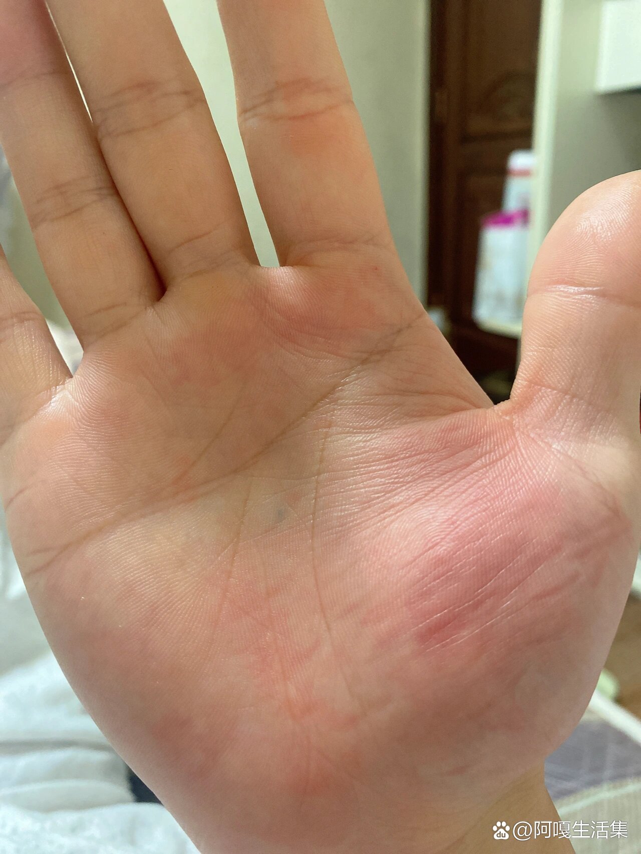 一到晚上手掌心就痒