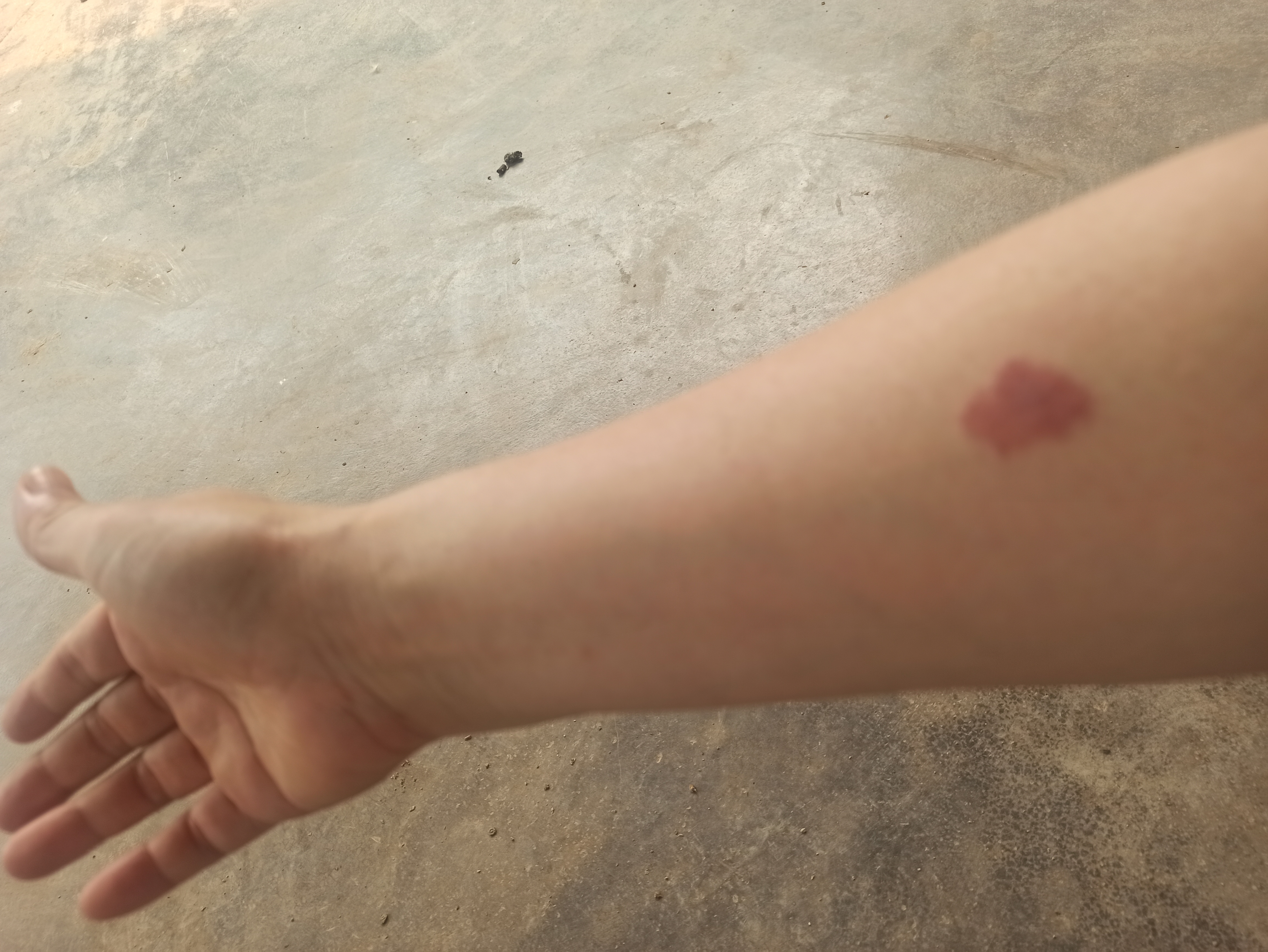 关于我手臂上这个红印,多年来记不清有多少人关心过,几乎都是这样问我