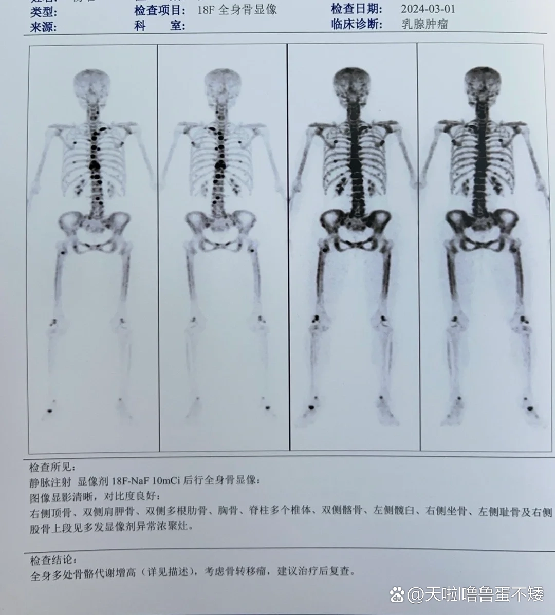 全身多发骨转移