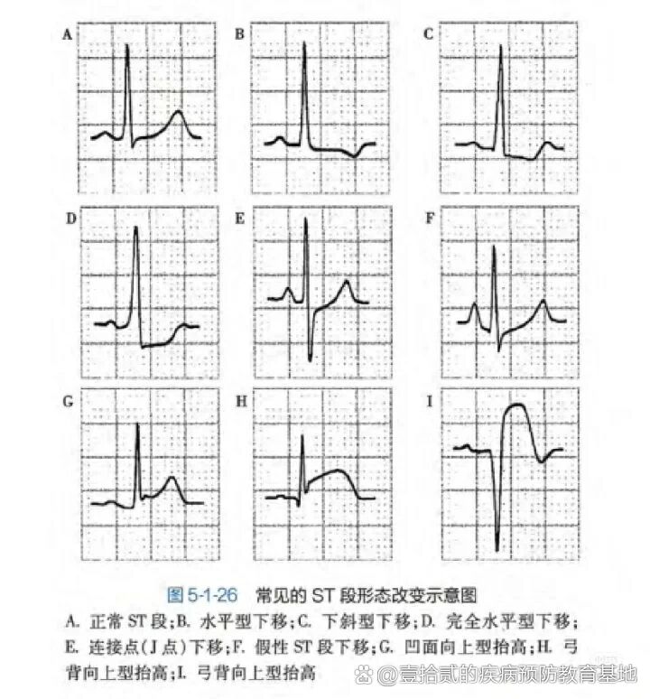 心电图10mmmv25mms50hz图片