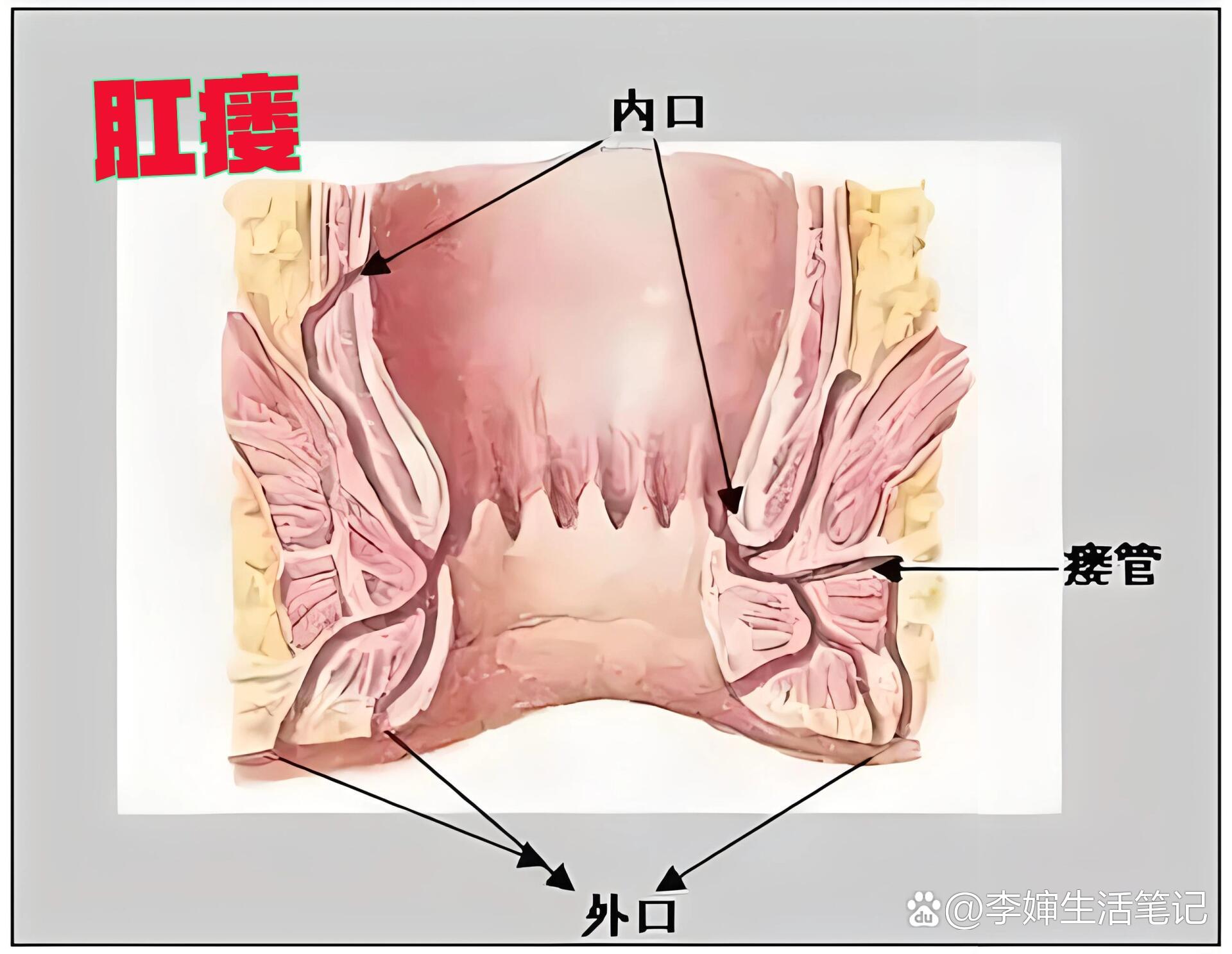 肛瘘手术后恢复过程图图片