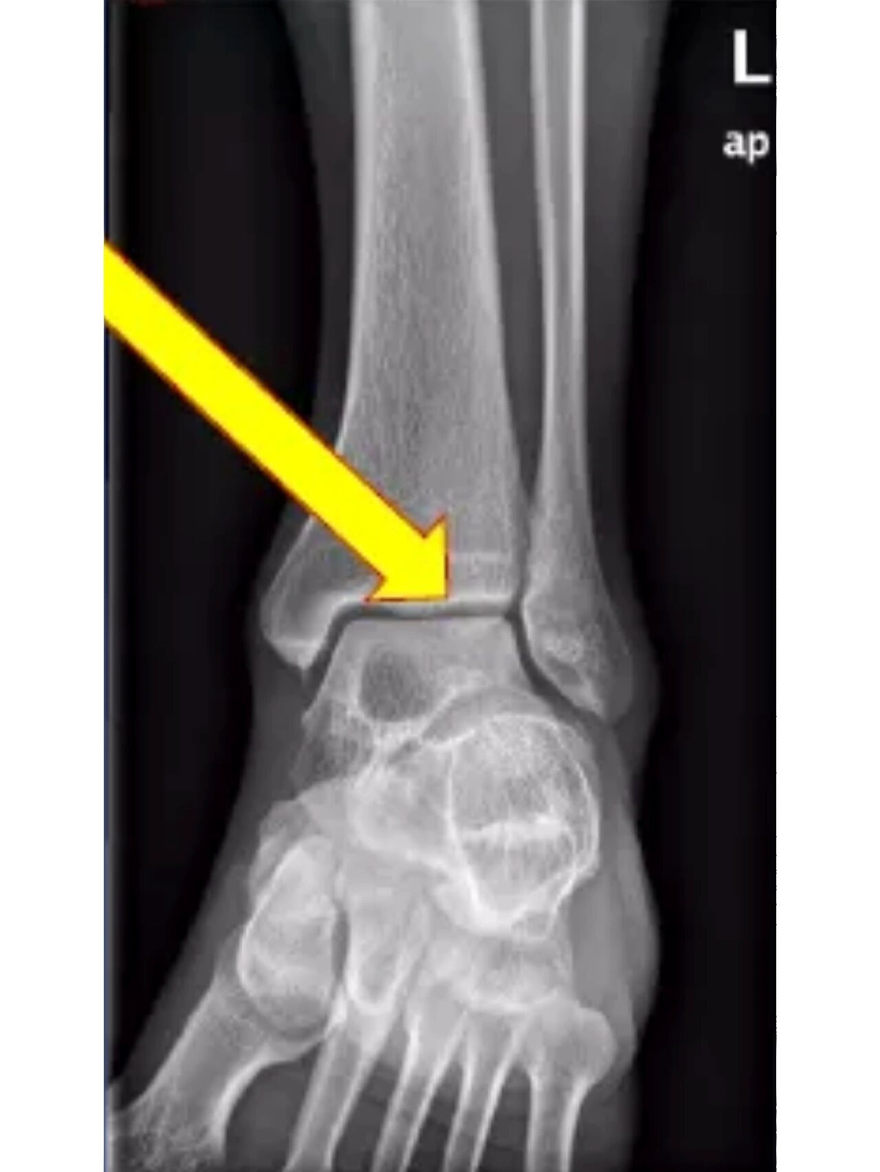 如何拍出标准的踝关节正侧位