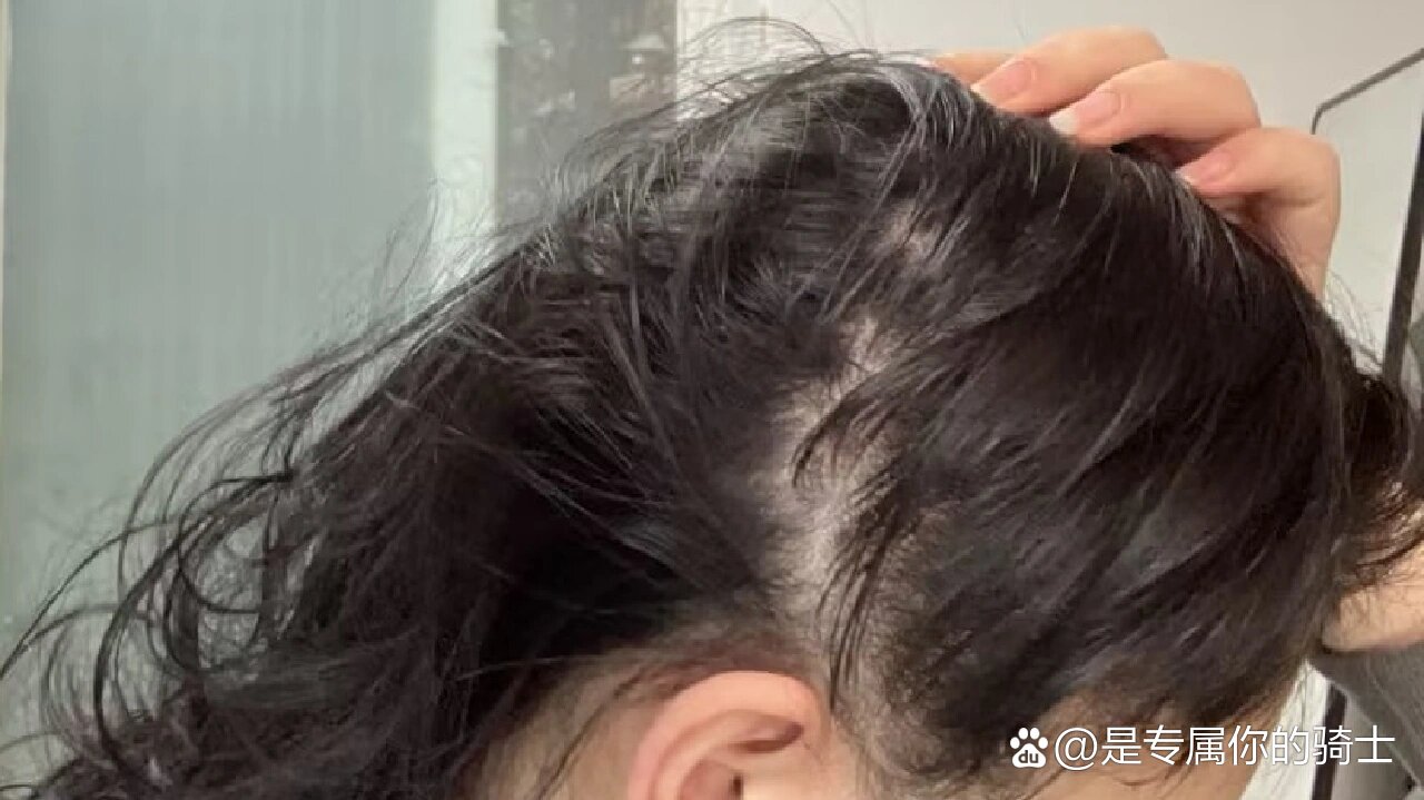 侧面头发稀疏脱发严重