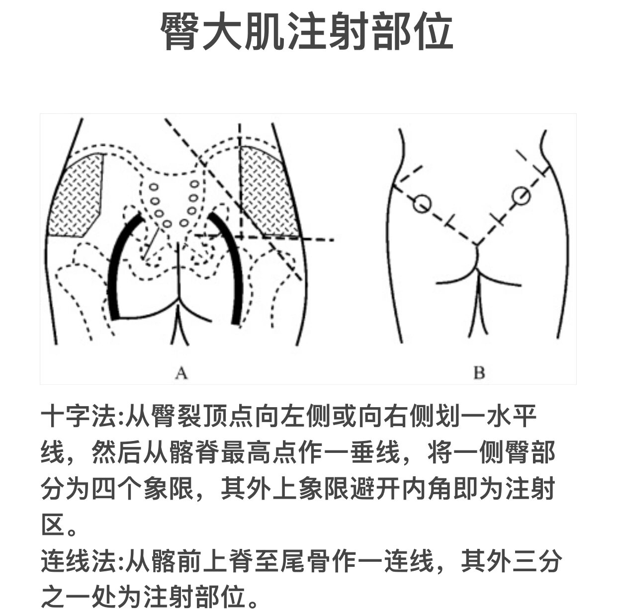 肌内注射连线法图片图片