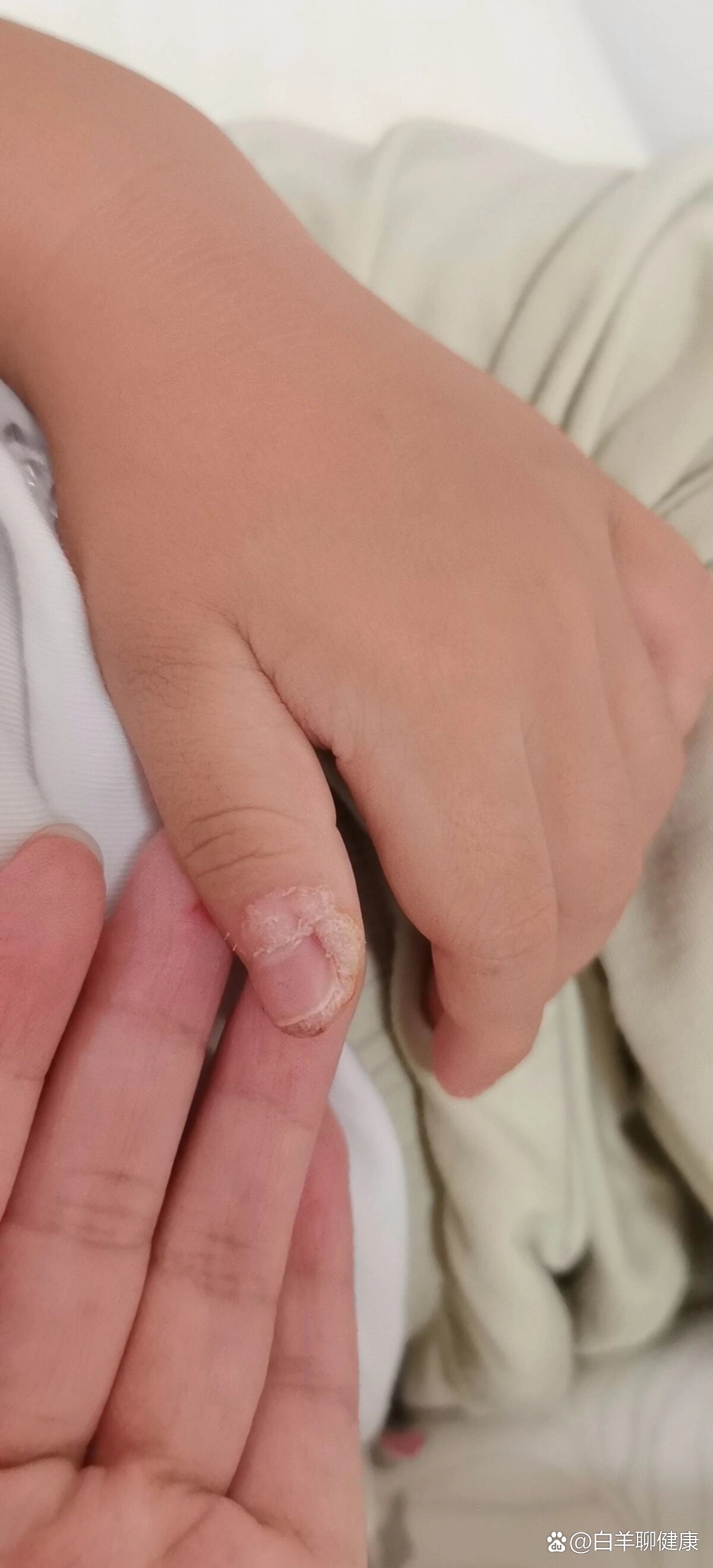 终于找到了治疗儿童甲周疣的方法