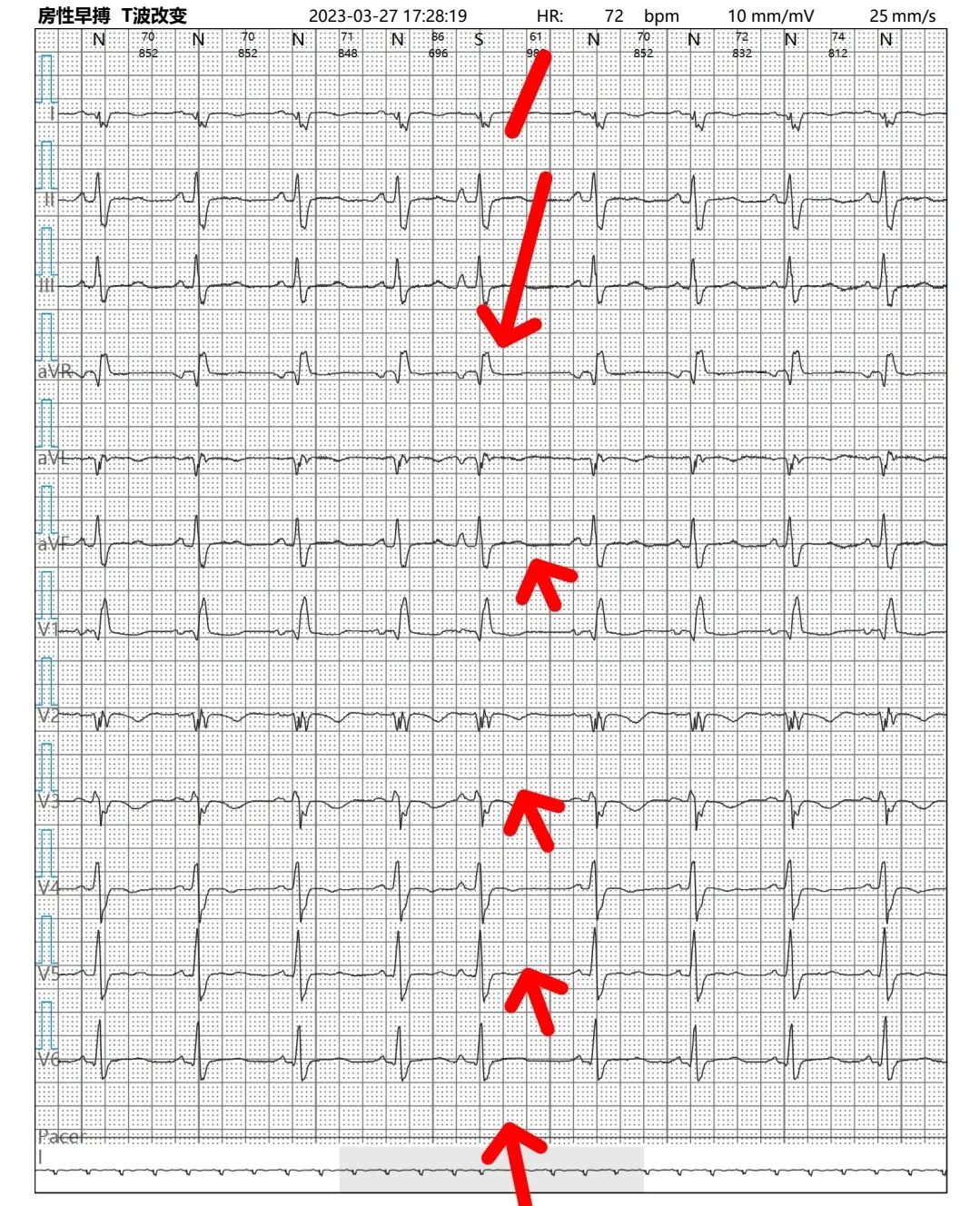 频发室早心电图图片