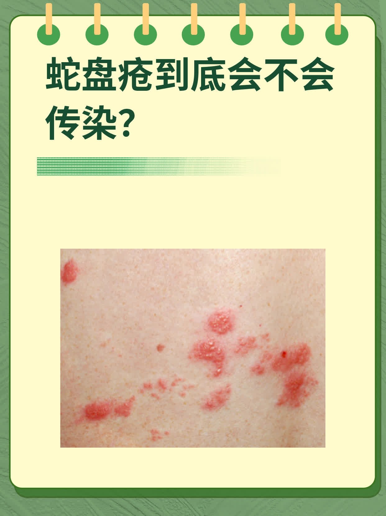 蛇盘疮到底会不会传染