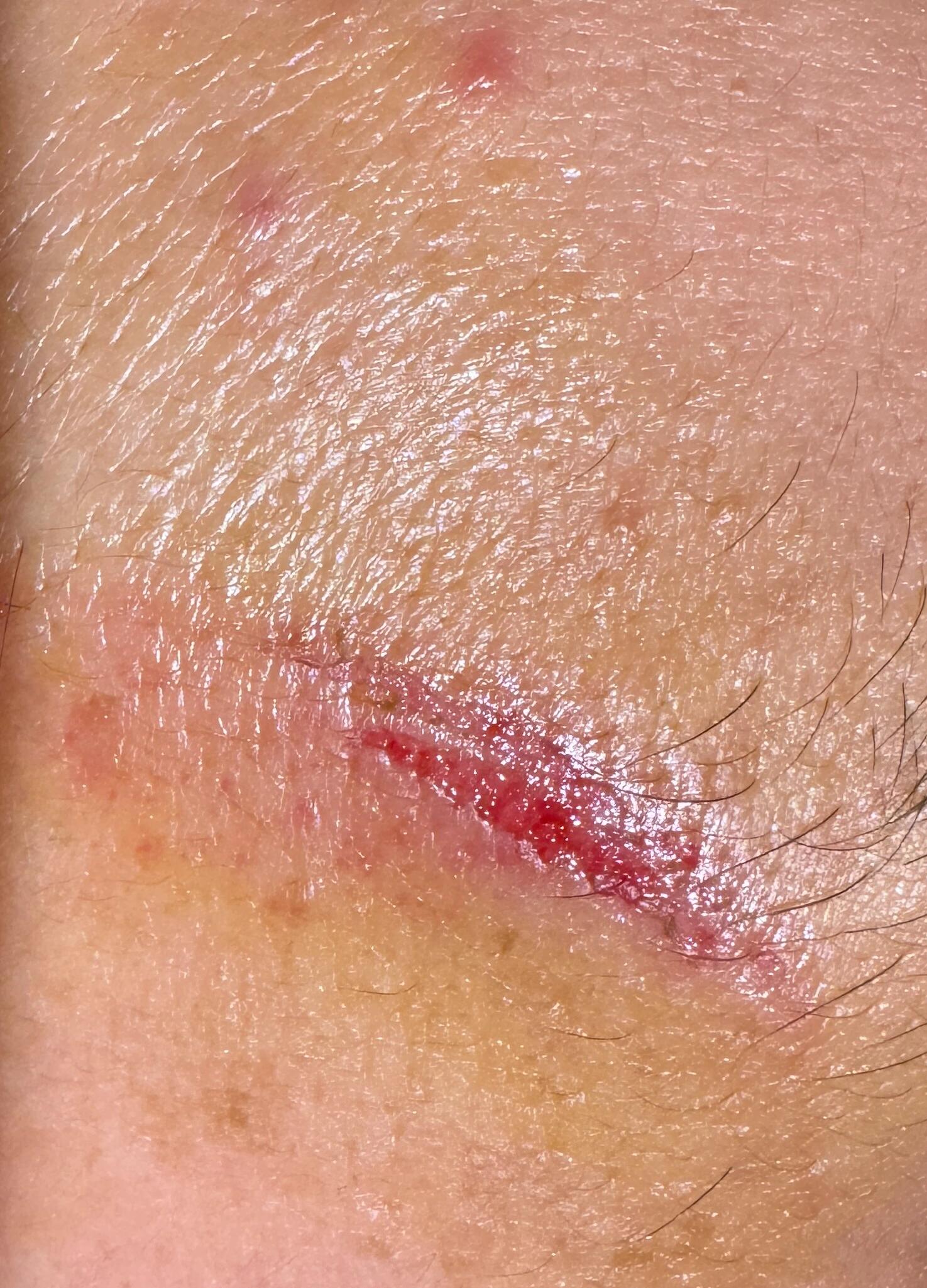 被生锈的铁栏杆划破皮流血了需要打破伤风吗