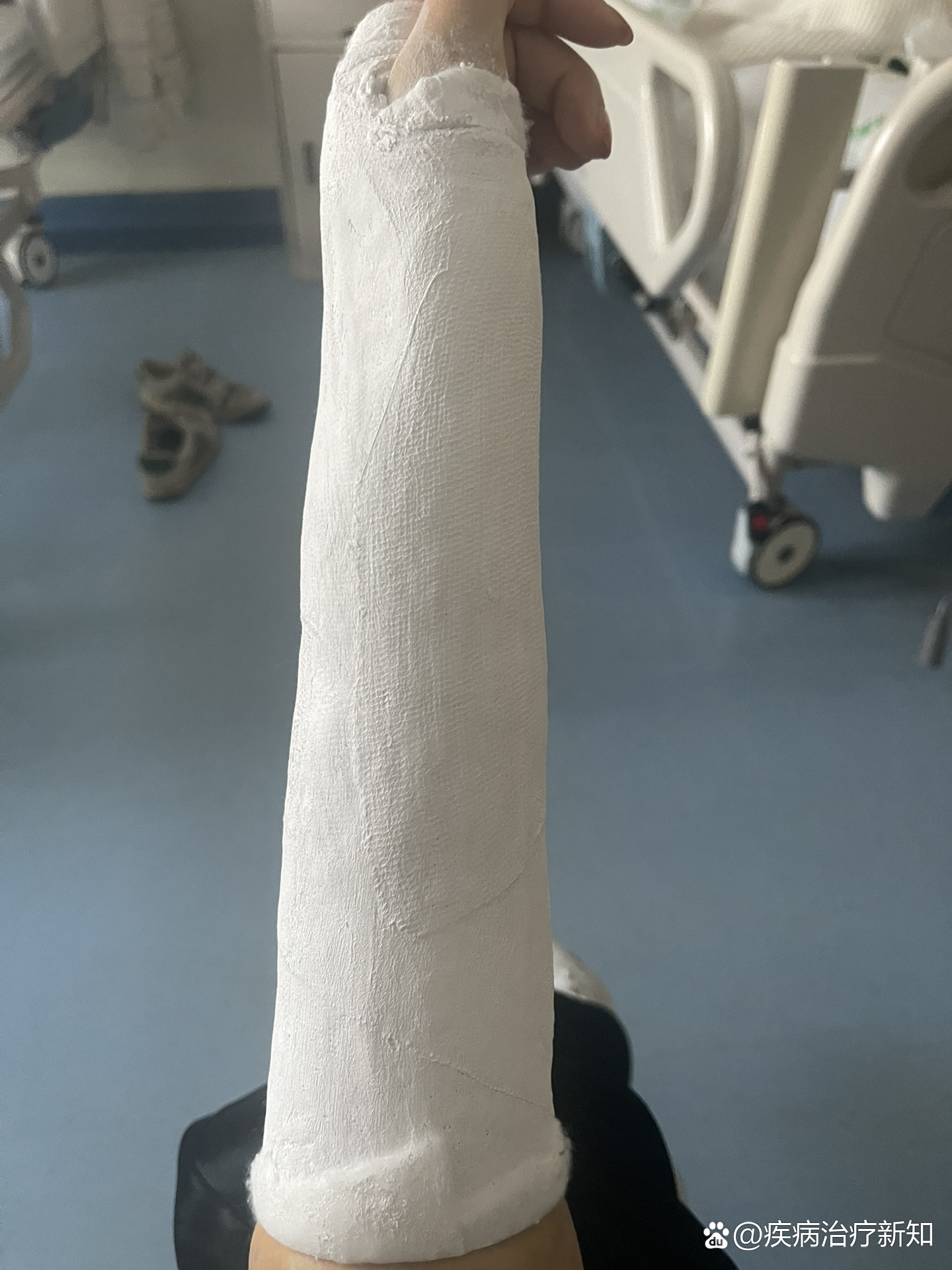 左手手腕桡骨远端粉碎性骨折,记录四次石膏