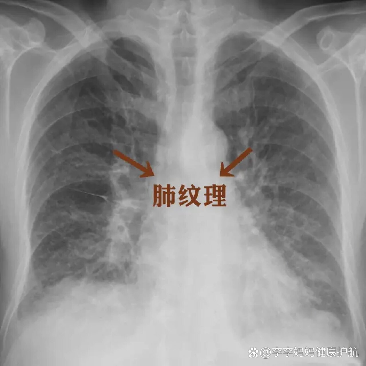 肺纹理增多什么意思,哪些疾病信号?