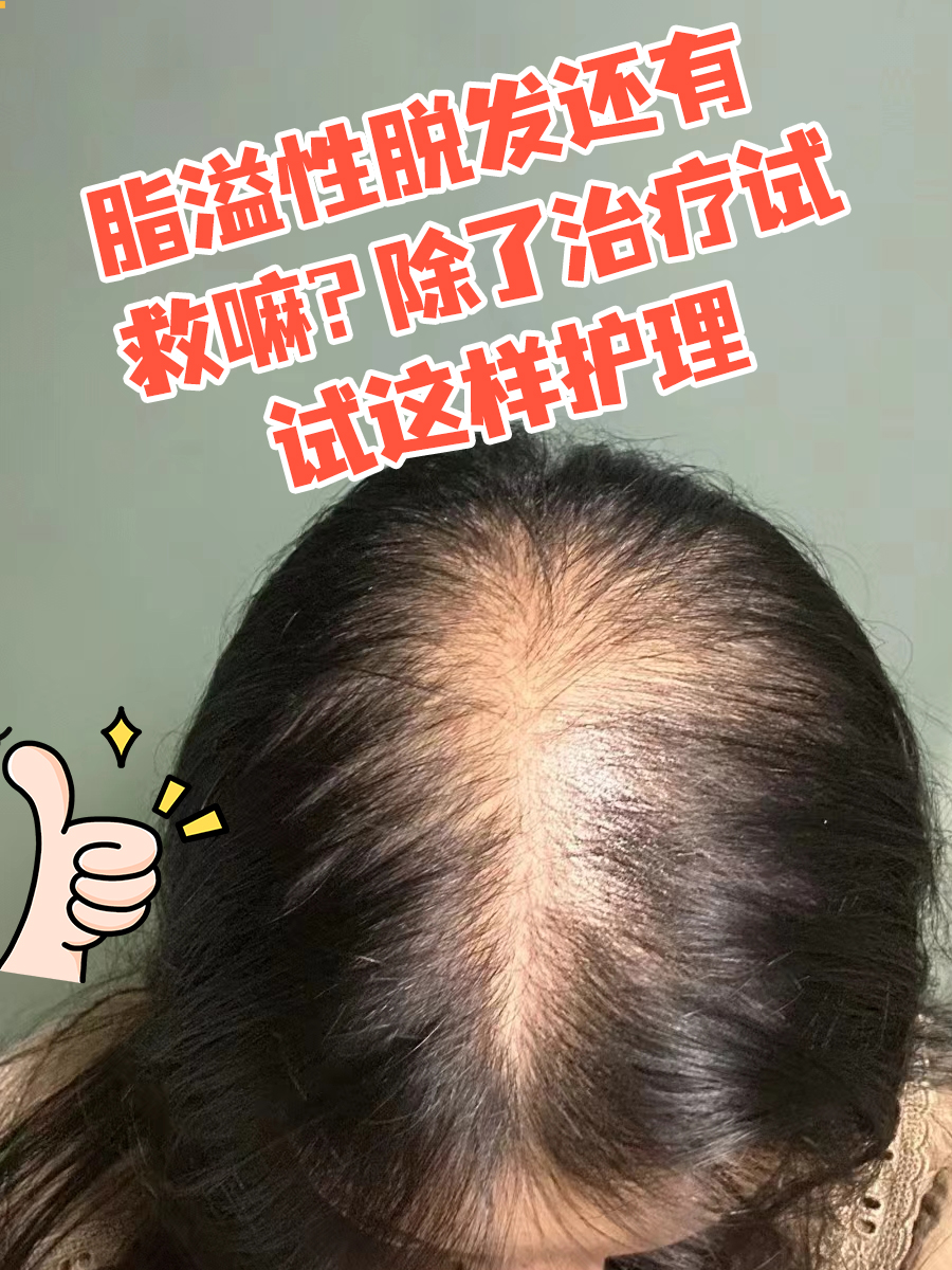 脂溢性脱发还有救嘛?除了治疗试试这样护理