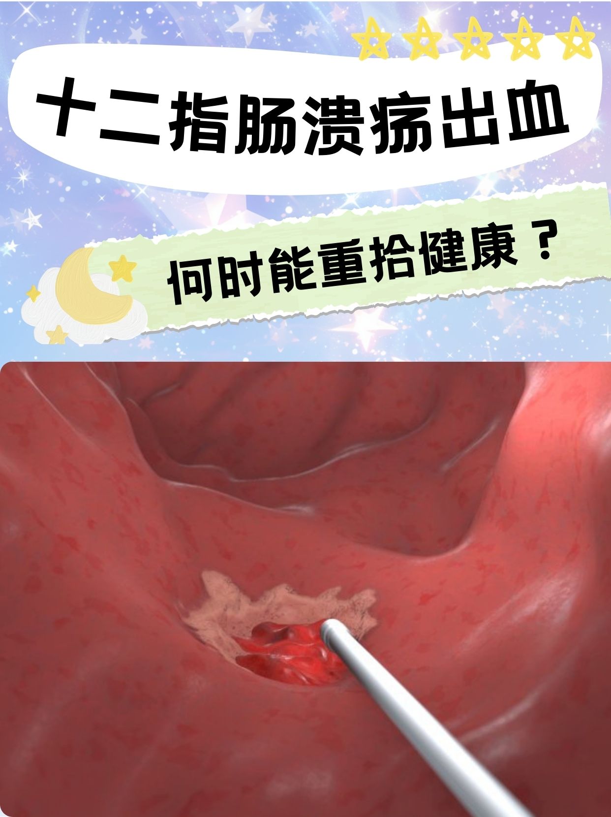 十二指肠溃疡出血何时能重拾健康?