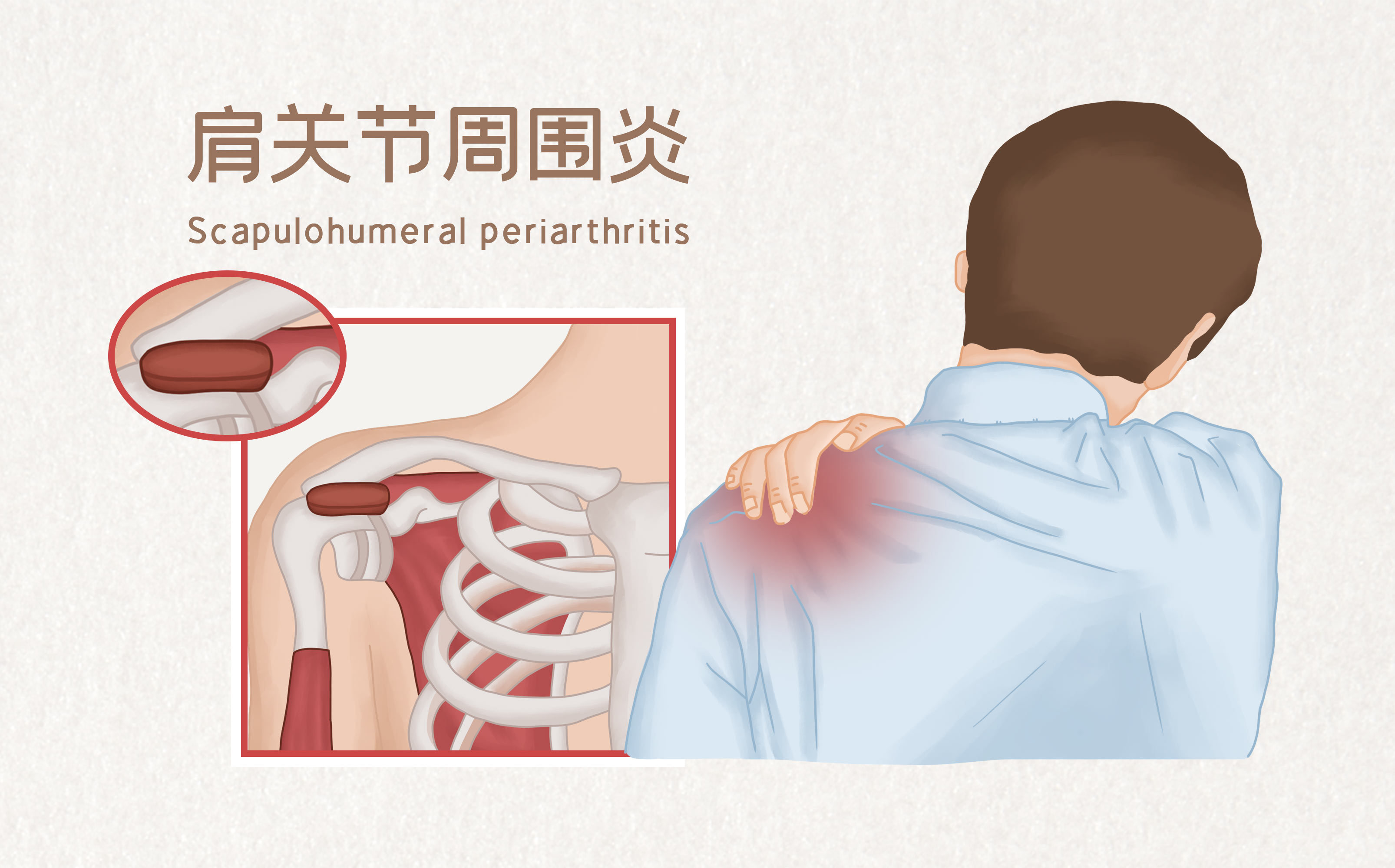 肩周炎哪里痛图片解析图片