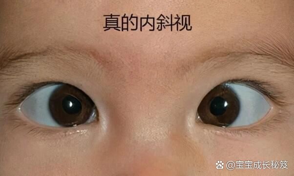 宝宝"斗鸡眼"正常吗?