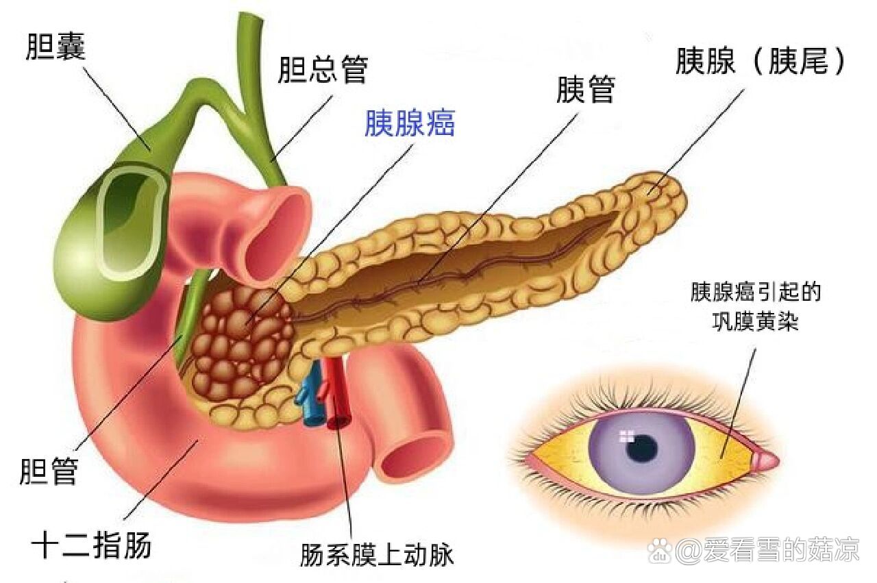 胰腺癌出现黄疸的原因和解决方案