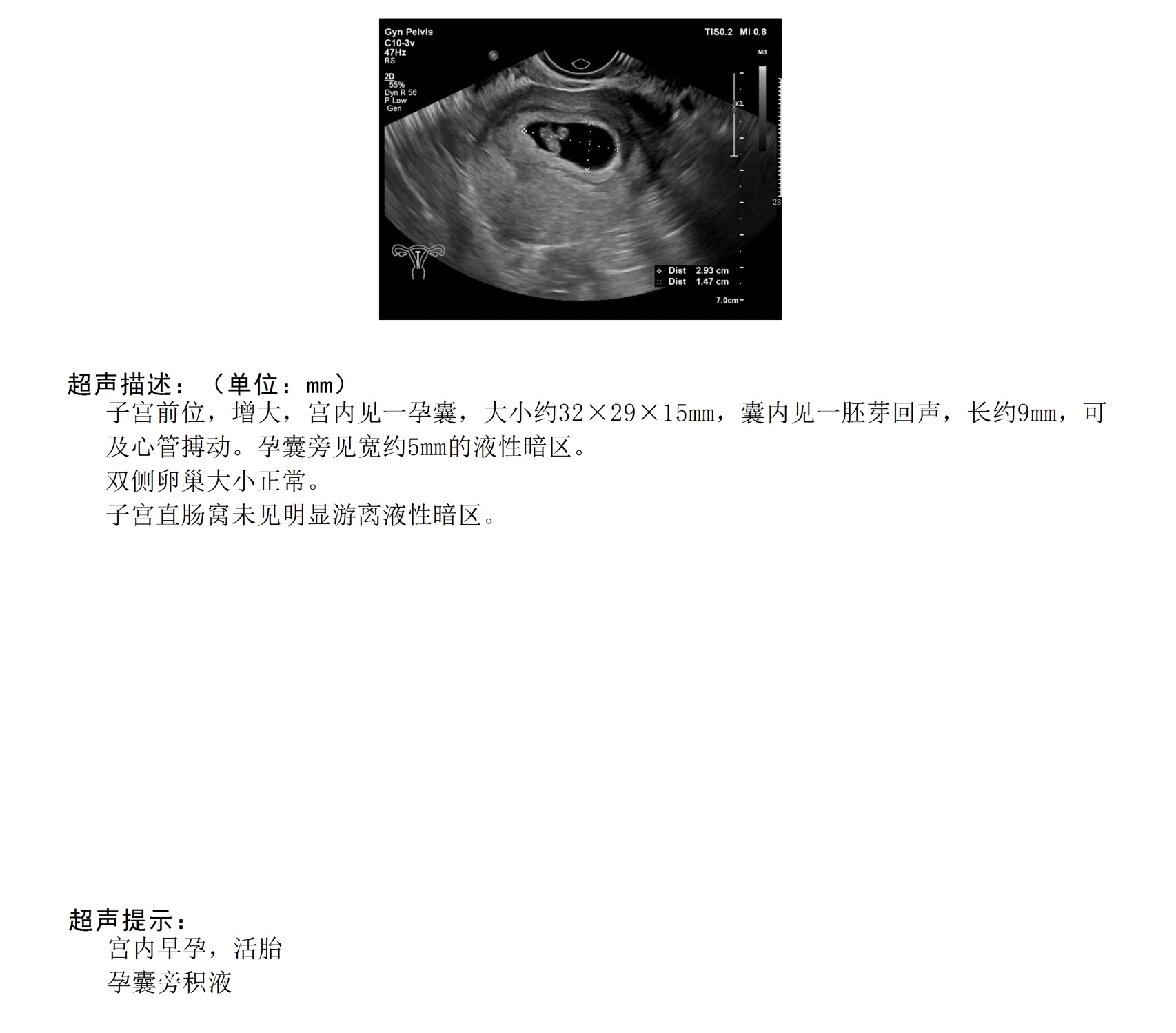 怀孕7周男孩孕囊图图片