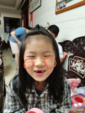 笑起来眼睛下面有个窝,这是啥