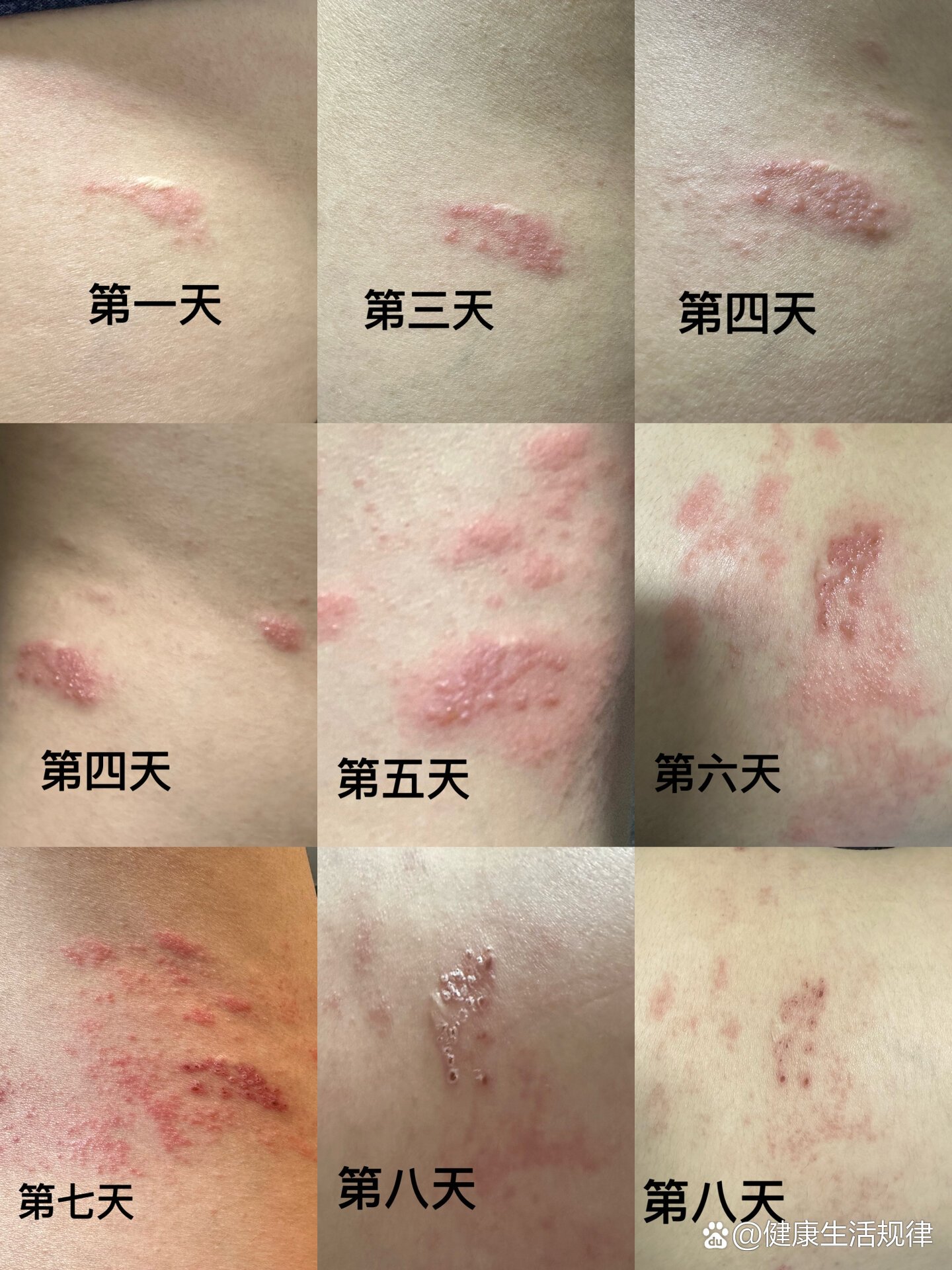 缠腰丹最快速治疗方法图片