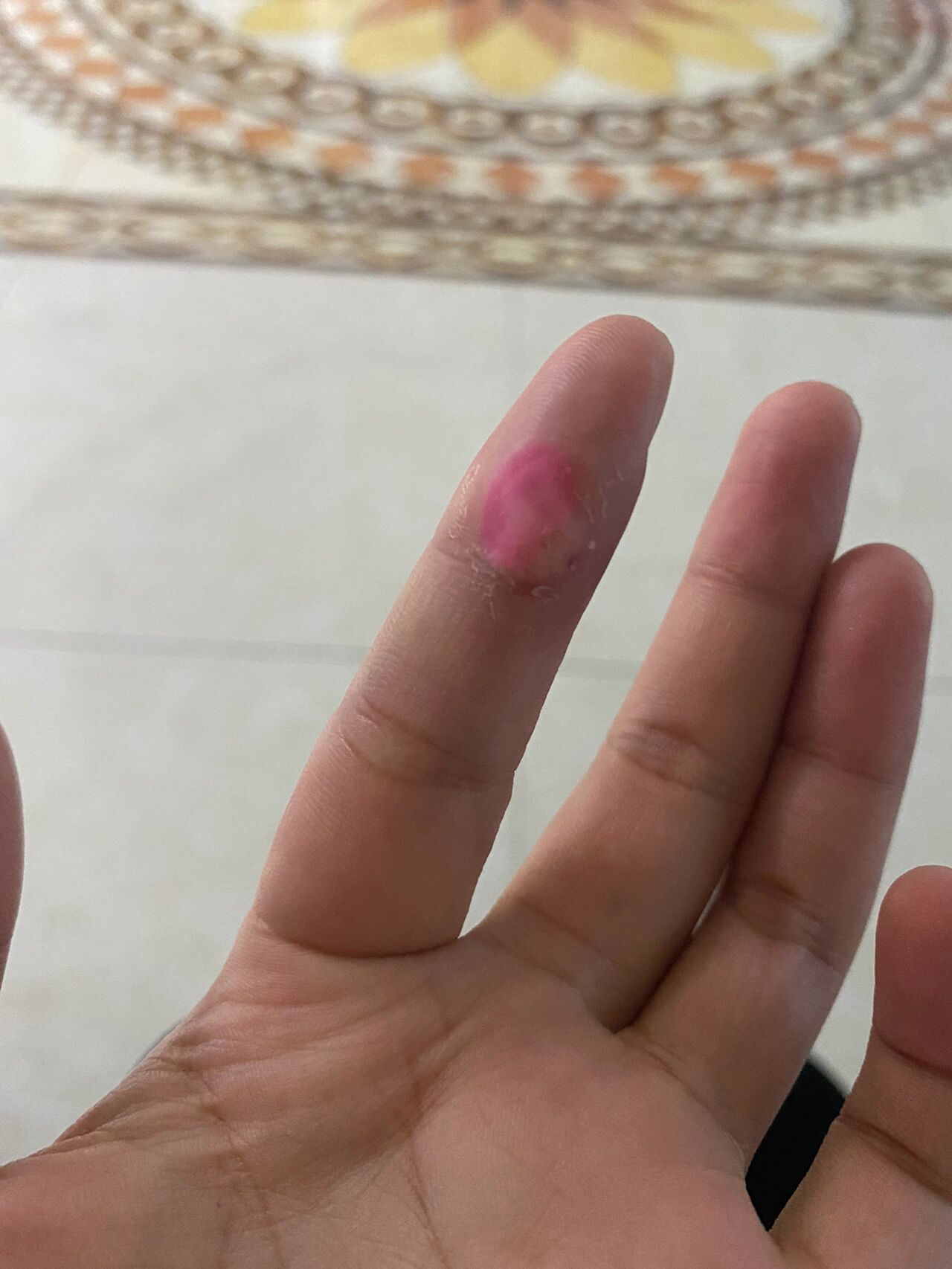 手上长疣激光治疗